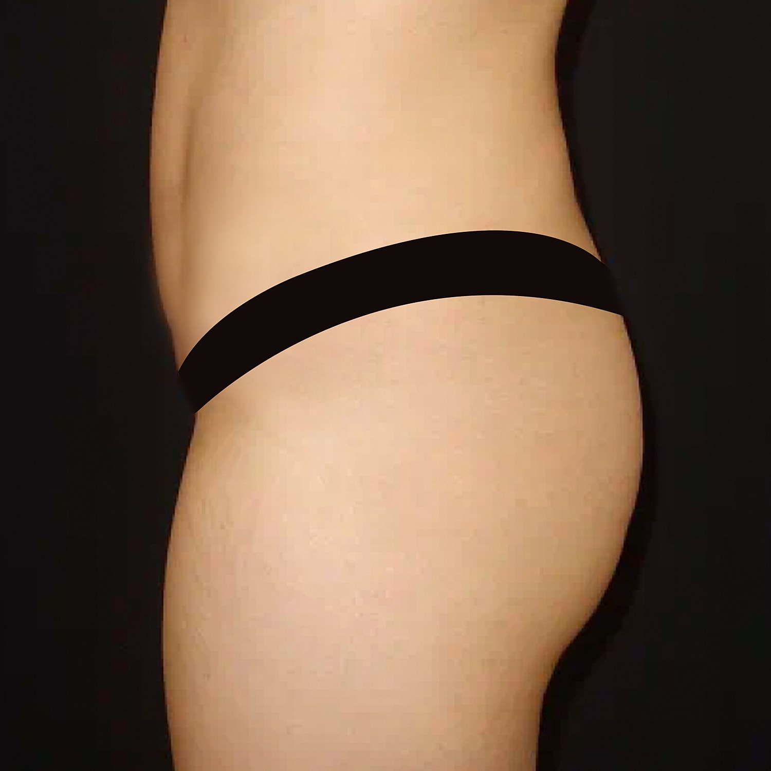 Brazilian Butt Lift Before & After