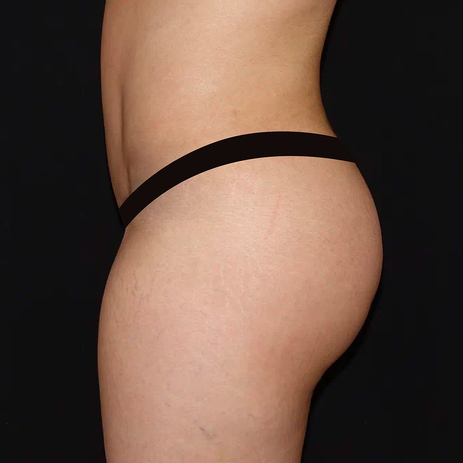 Brazilian Butt Lift Before & After