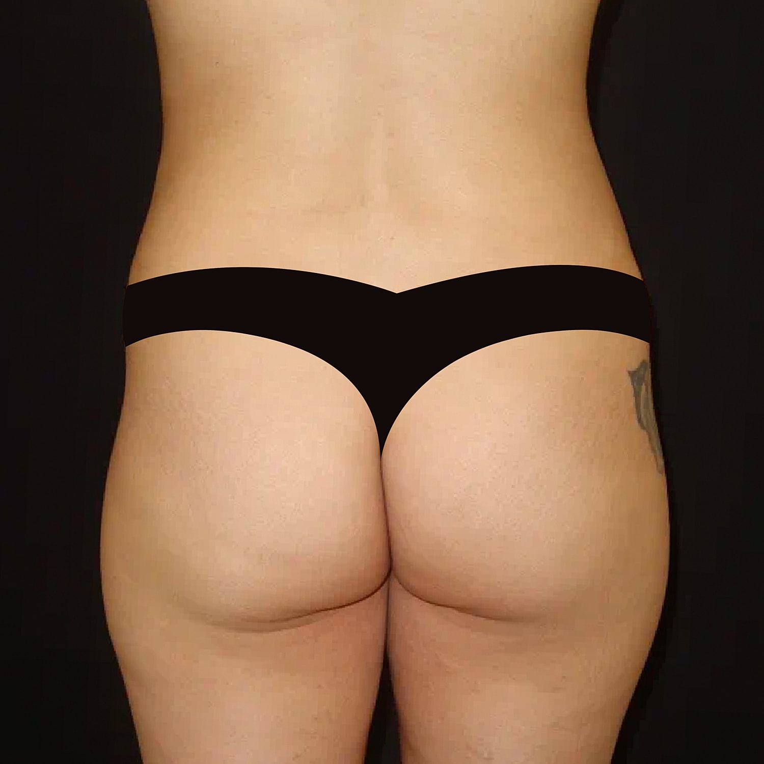 Brazilian Butt Lift Before & After