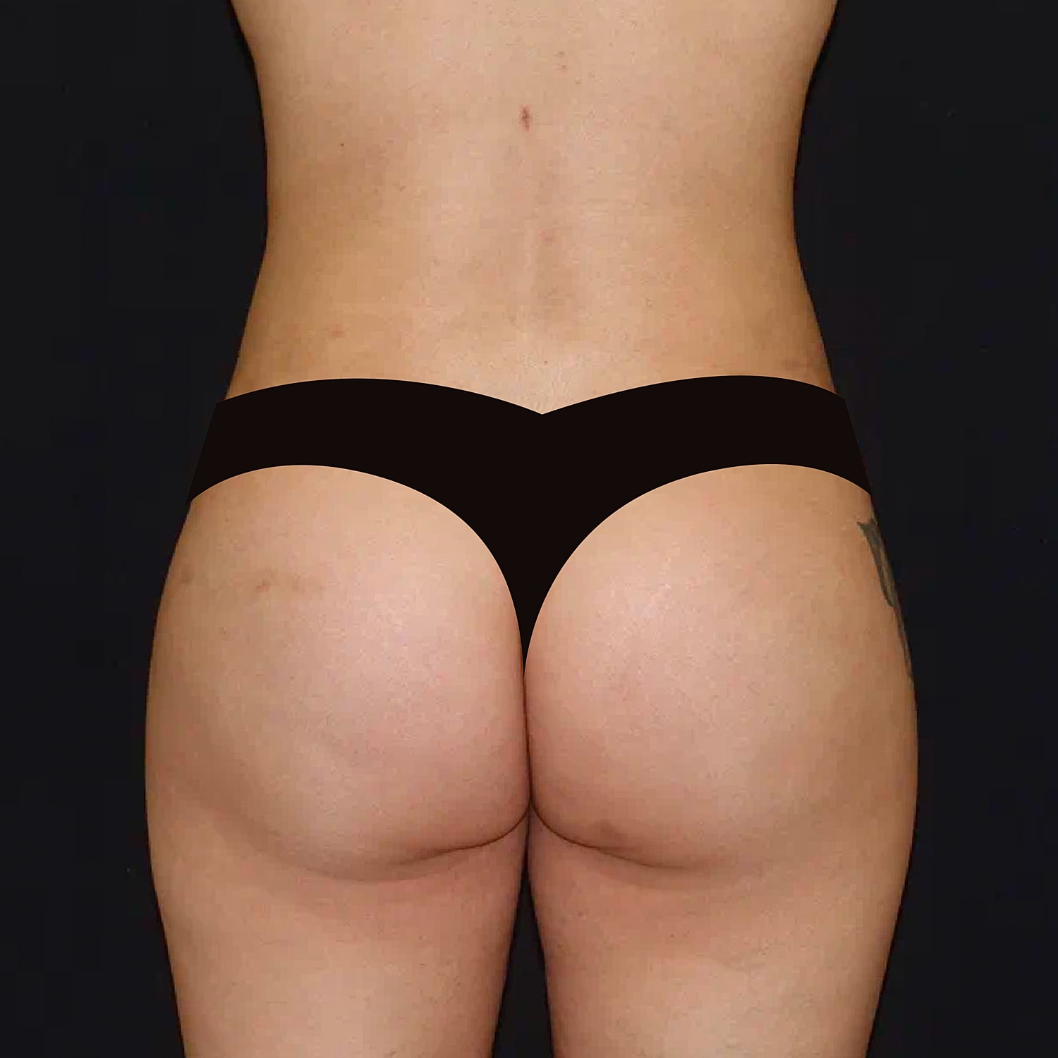 Brazilian Butt Lift Before & After
