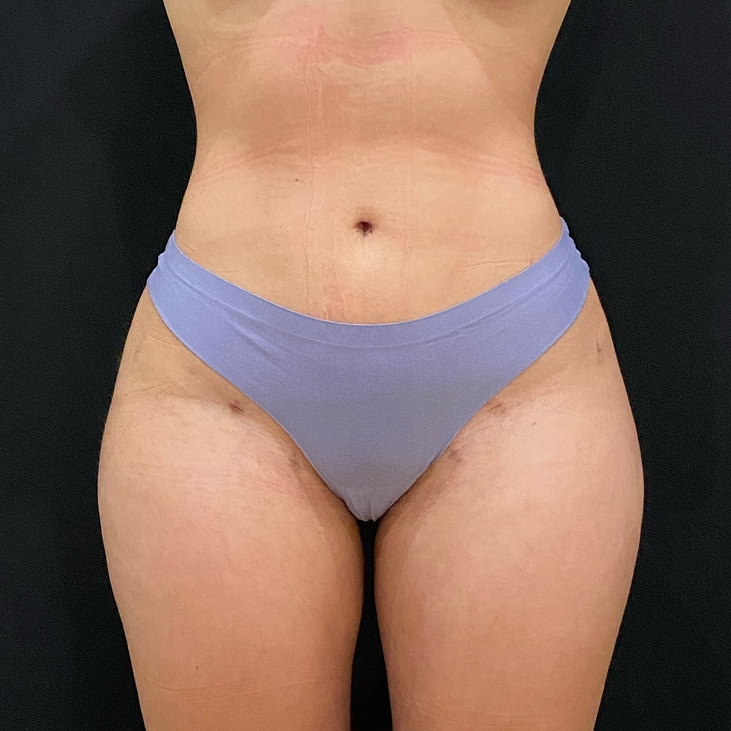 Brazilian Butt Lift Before & After
