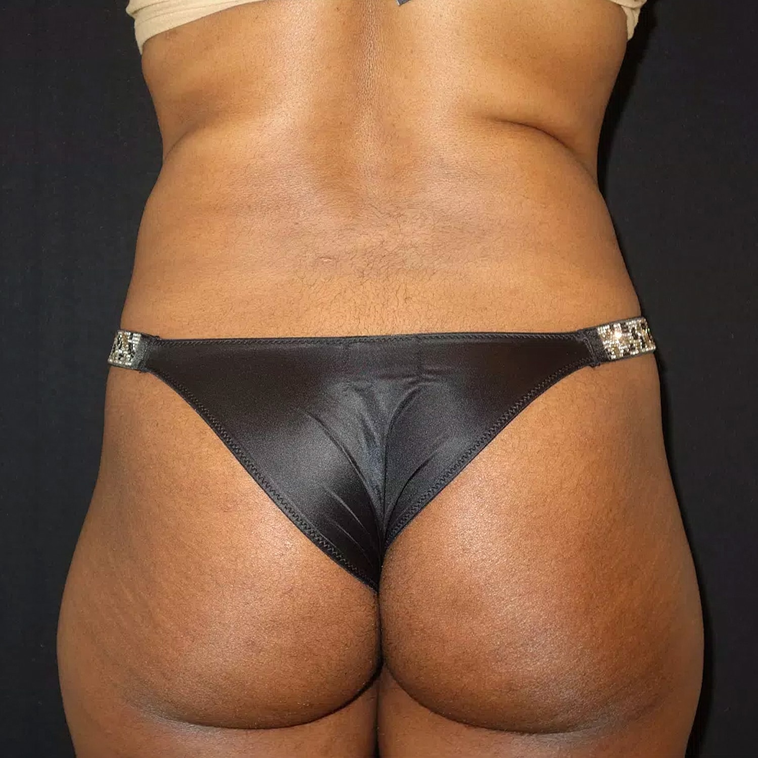 Brazilian Butt Lift Before & After
