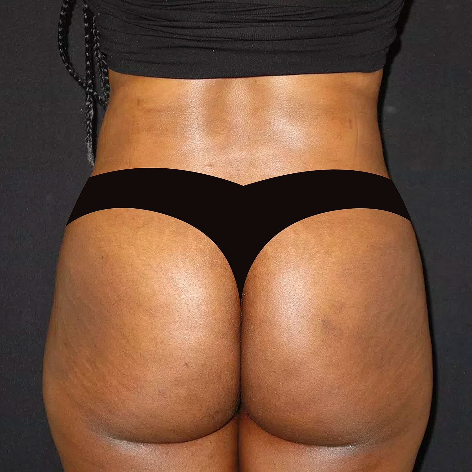 Brazilian Butt Lift Before & After