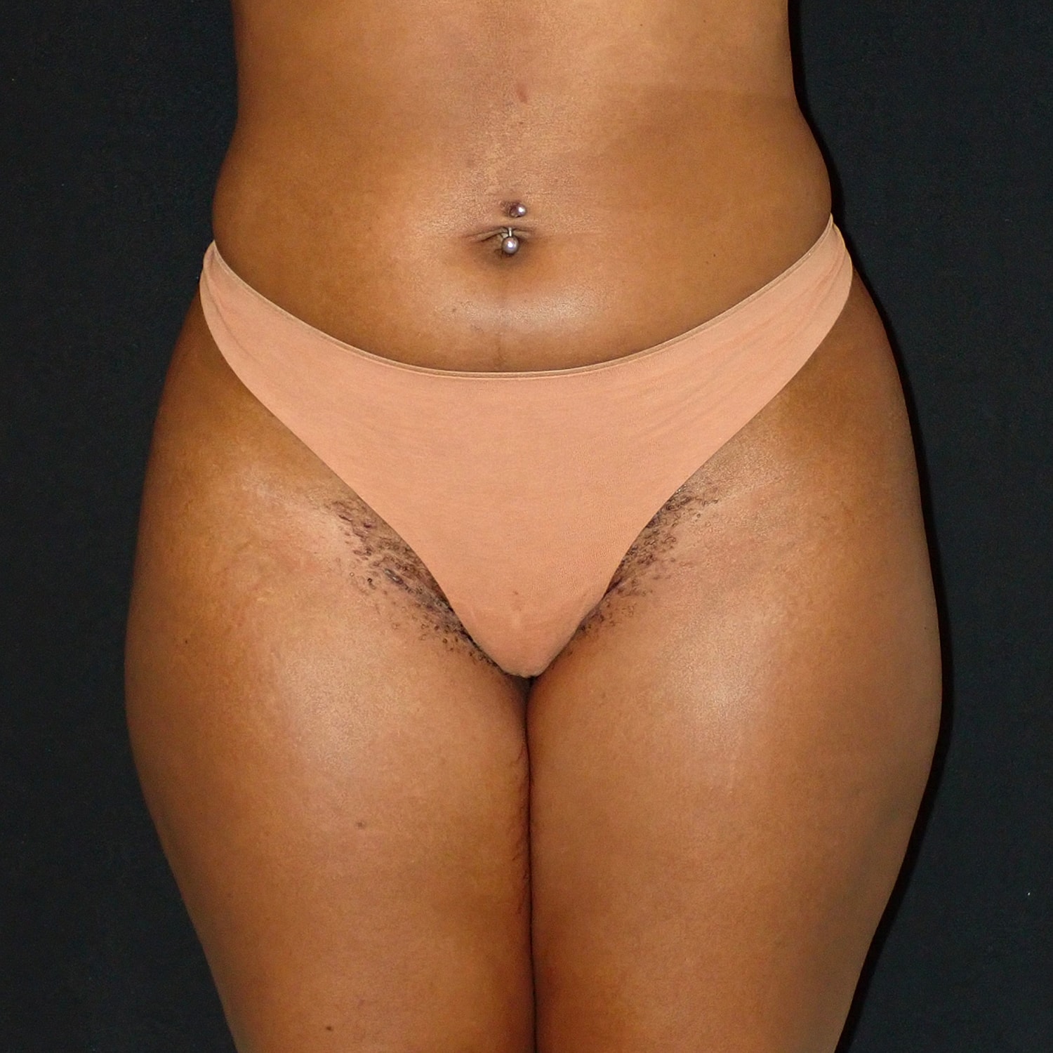 Brazilian Butt Lift Before & After