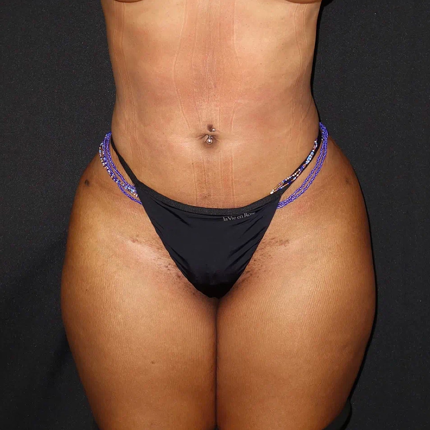 Brazilian Butt Lift Before & After