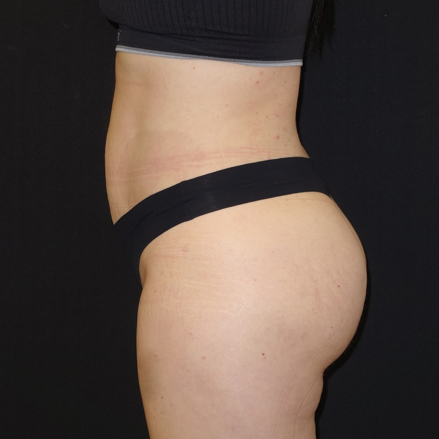 Brazilian Butt Lift Before & After