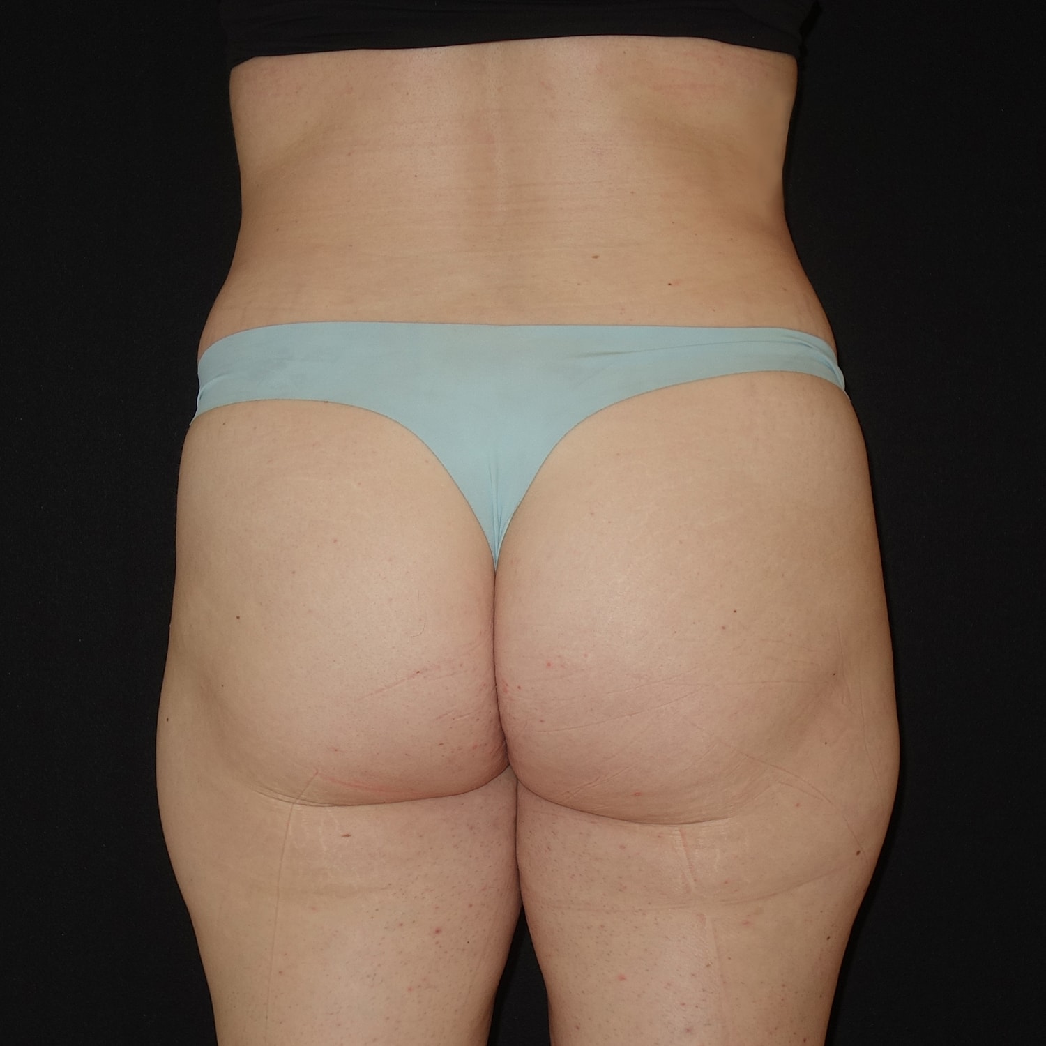 Brazilian Butt Lift Before & After
