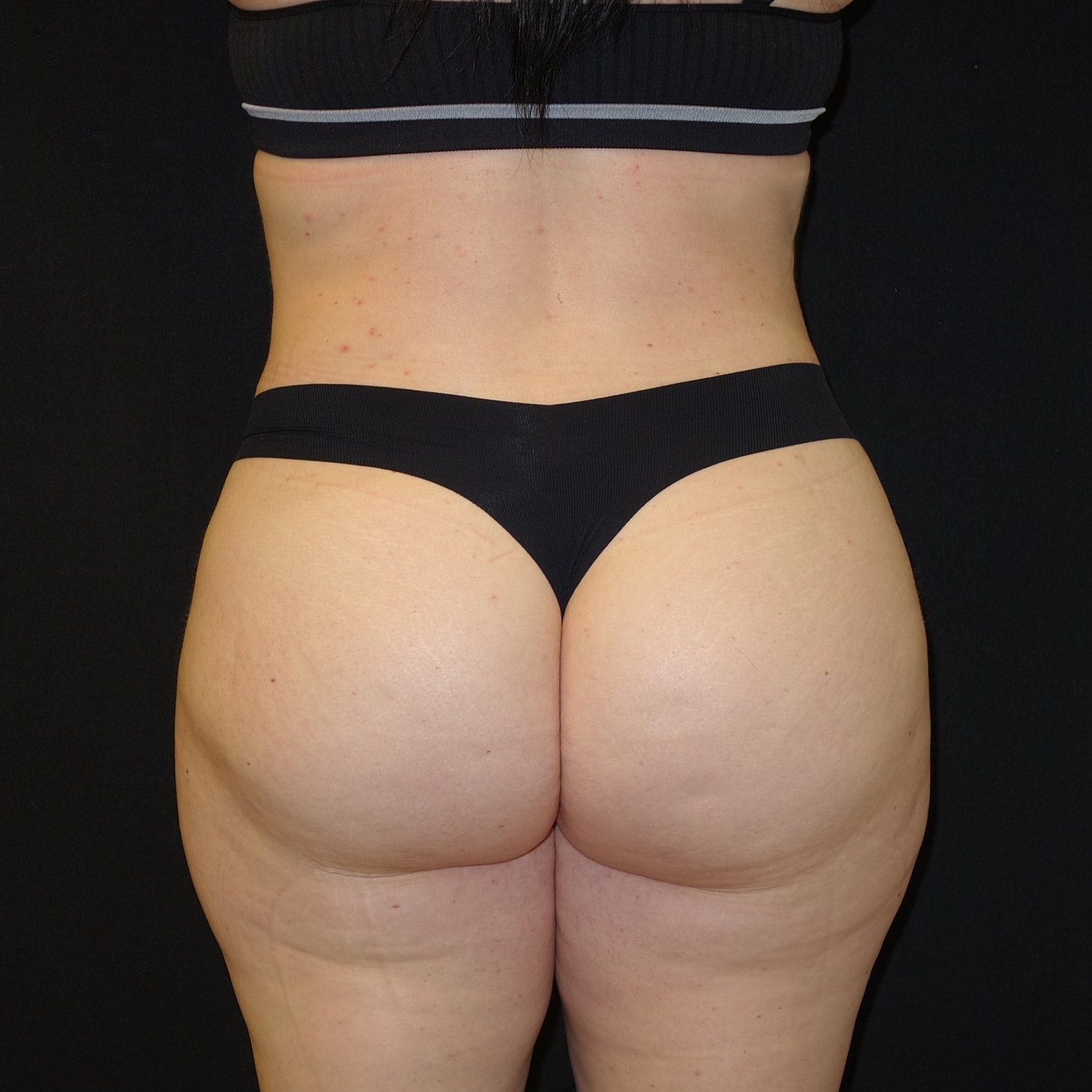 Brazilian Butt Lift Before & After