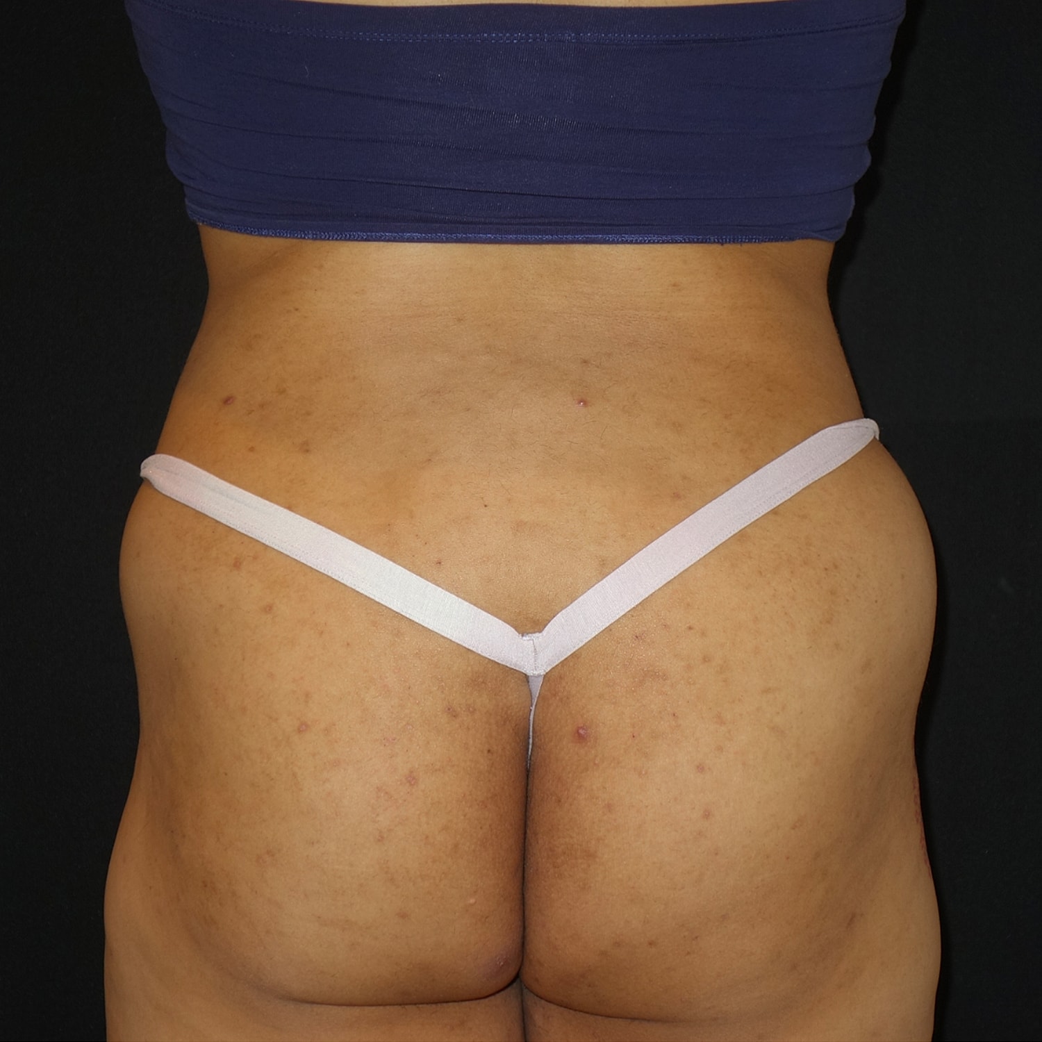 Brazilian Butt Lift Before & After