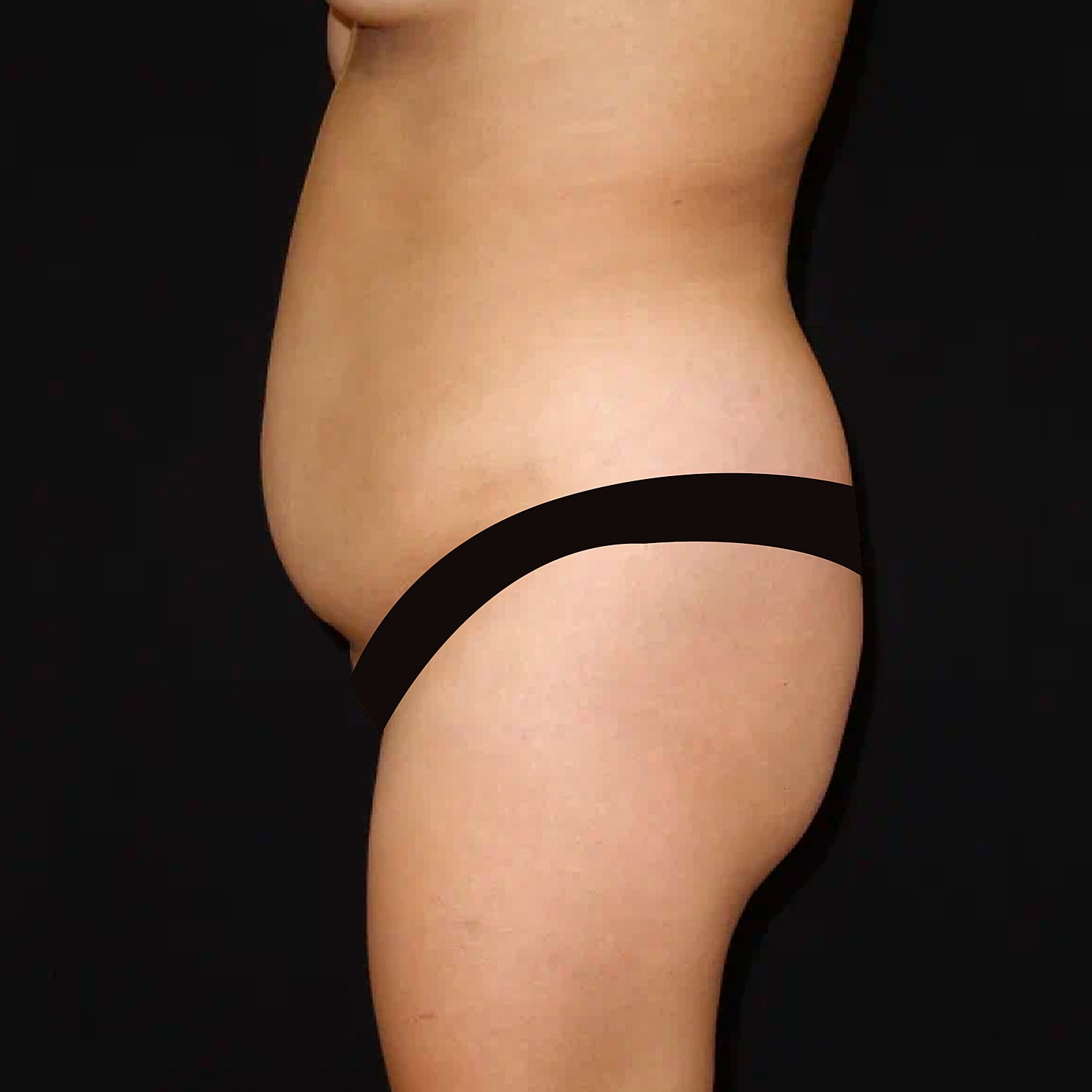 Brazilian Butt Lift Before & After
