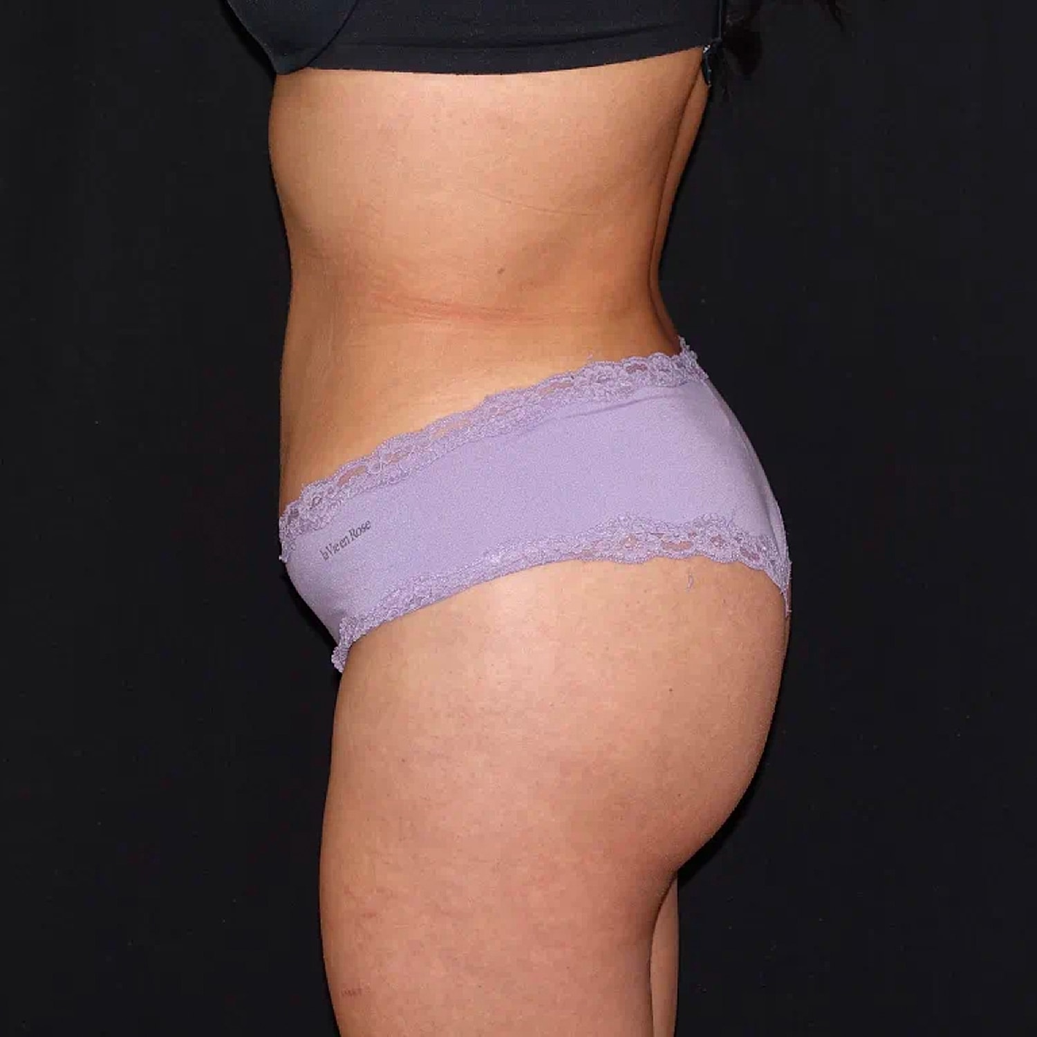 Brazilian Butt Lift Before & After