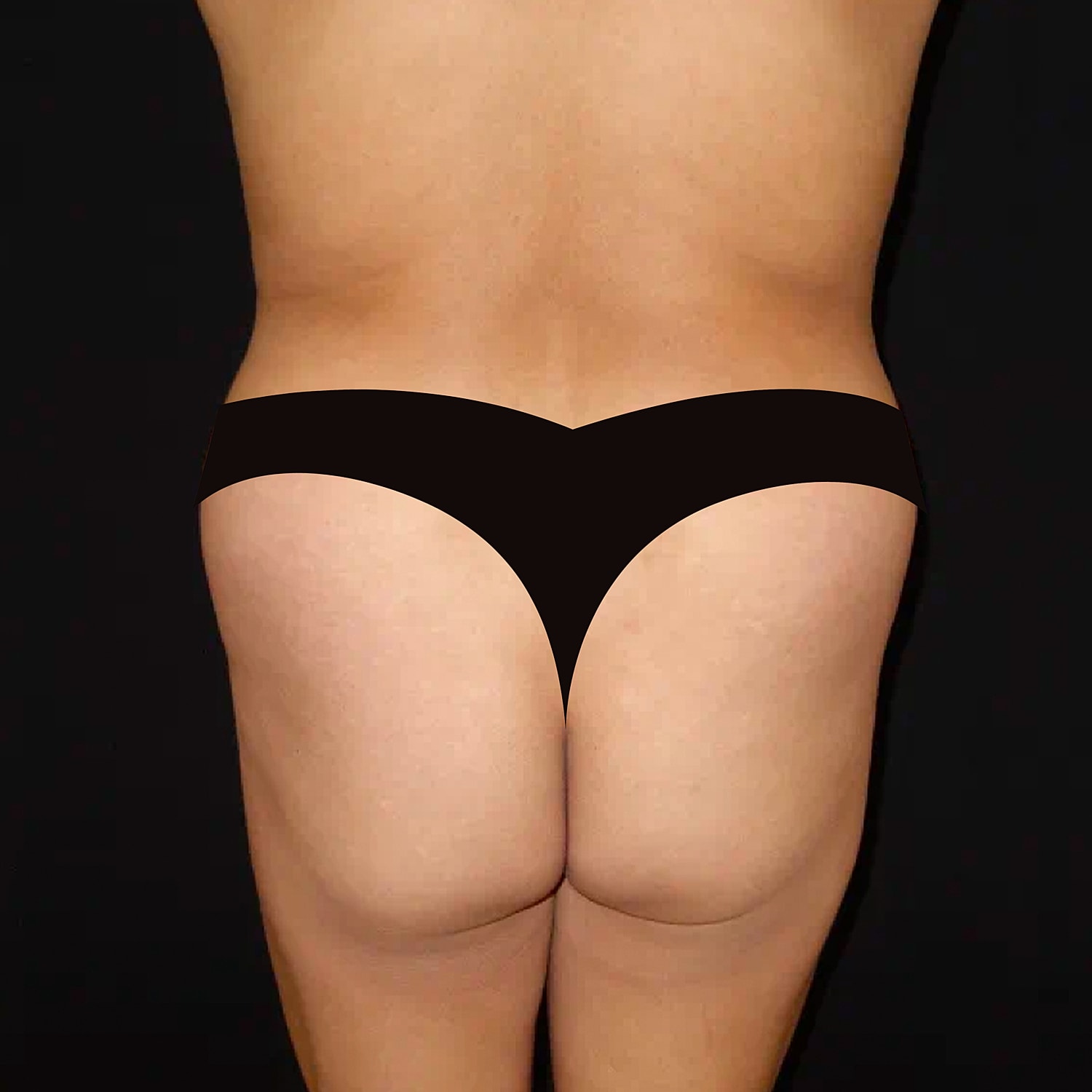 Brazilian Butt Lift Before & After
