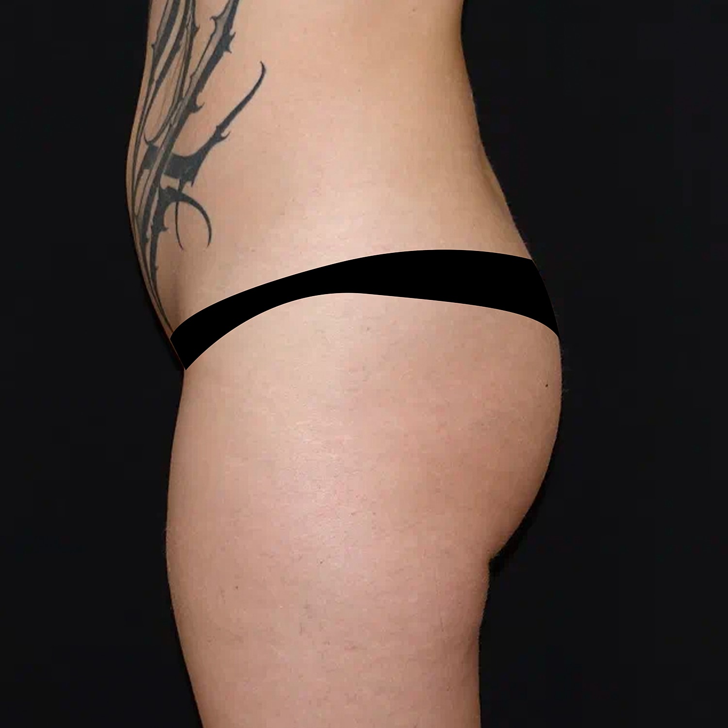 Brazilian Butt Lift Before & After