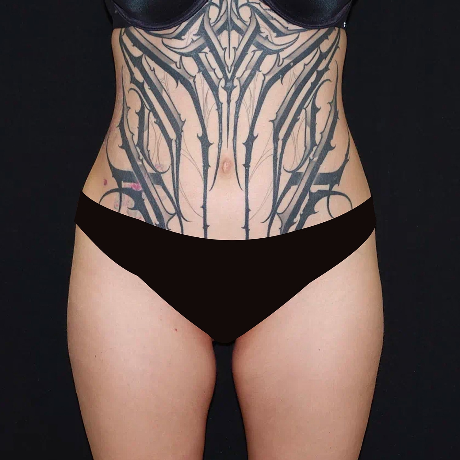 Brazilian Butt Lift Before & After