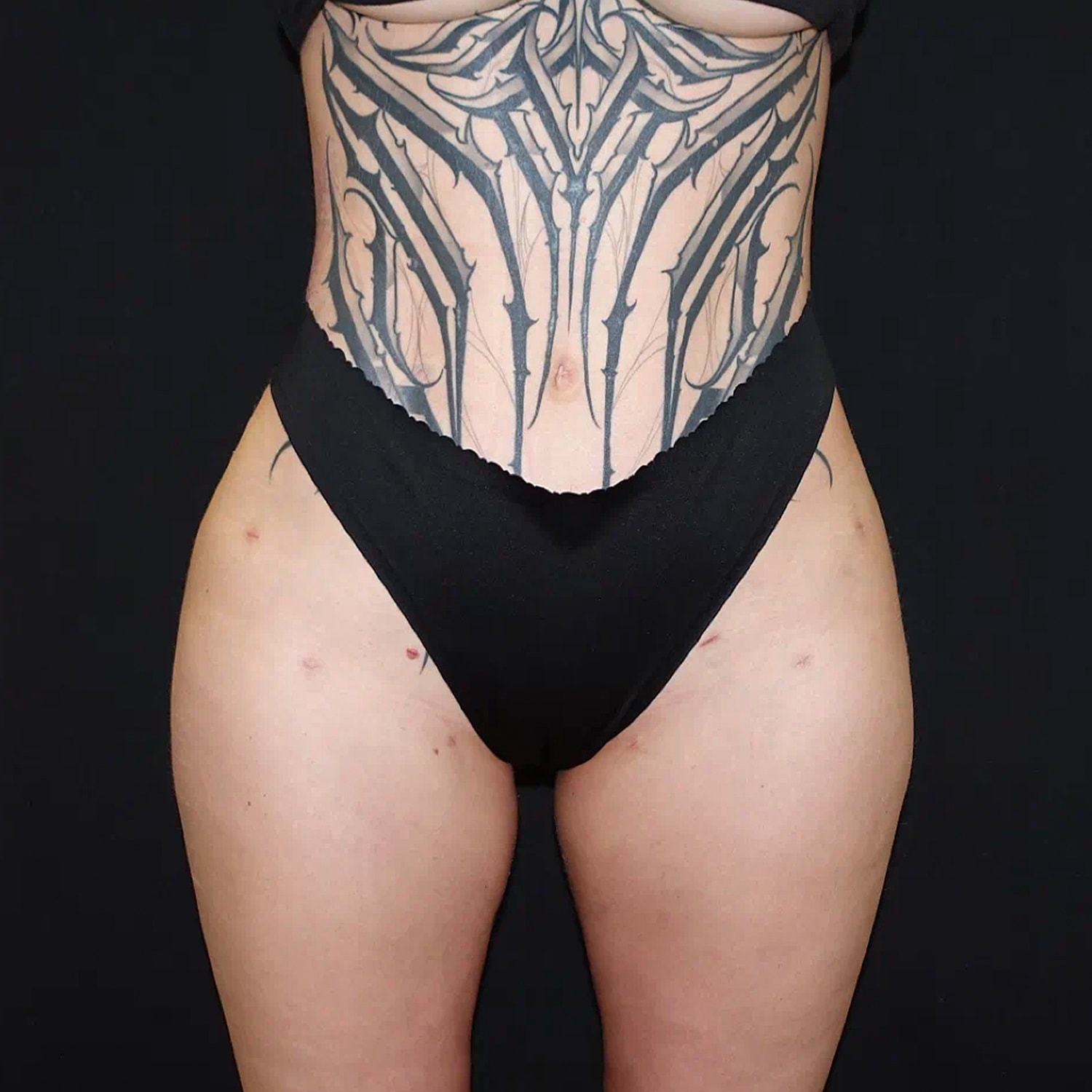 Brazilian Butt Lift Before & After