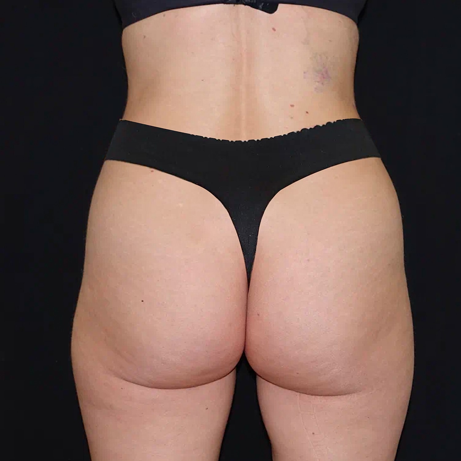 Brazilian Butt Lift Before & After