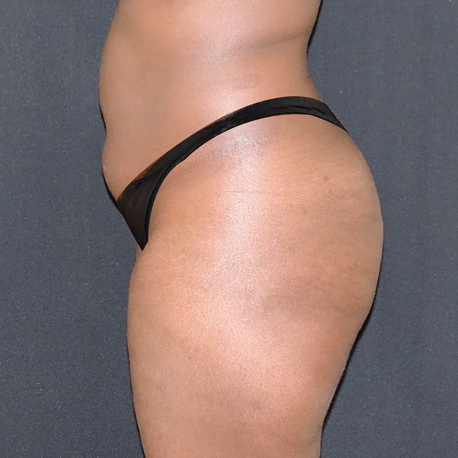 Brazilian Butt Lift Before & After