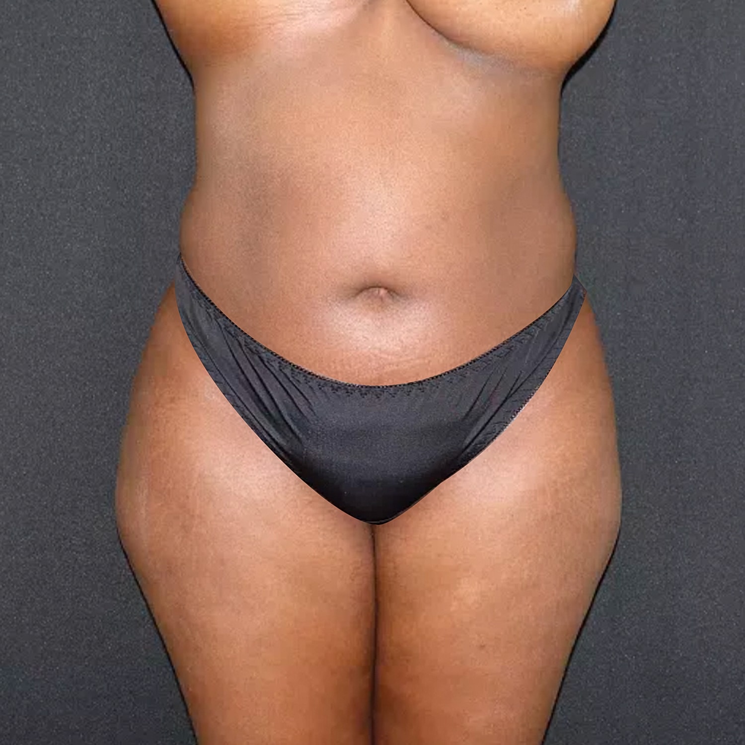 Brazilian Butt Lift Before & After