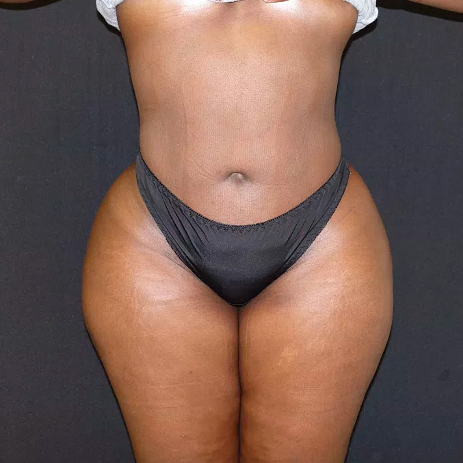 Brazilian Butt Lift Before & After