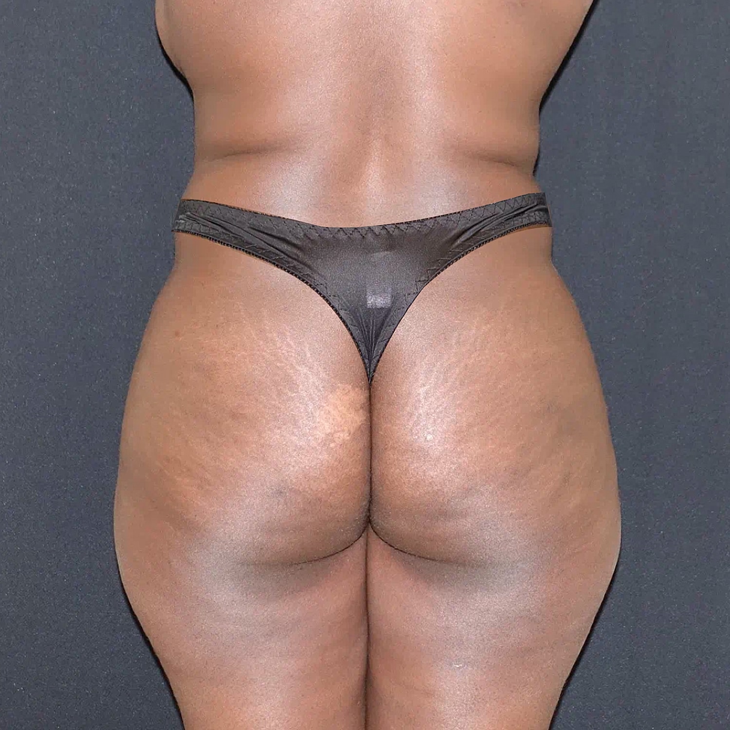 Brazilian Butt Lift Before & After