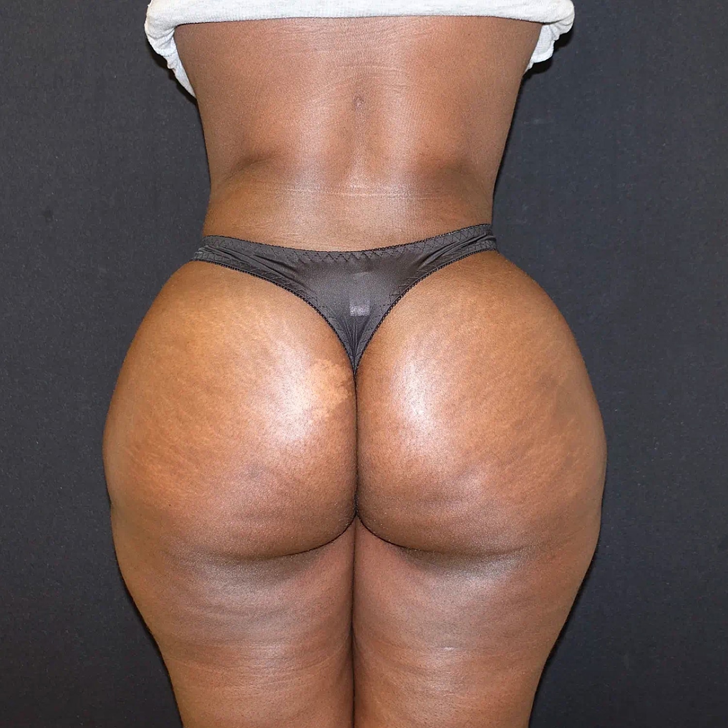 Brazilian Butt Lift Before & After