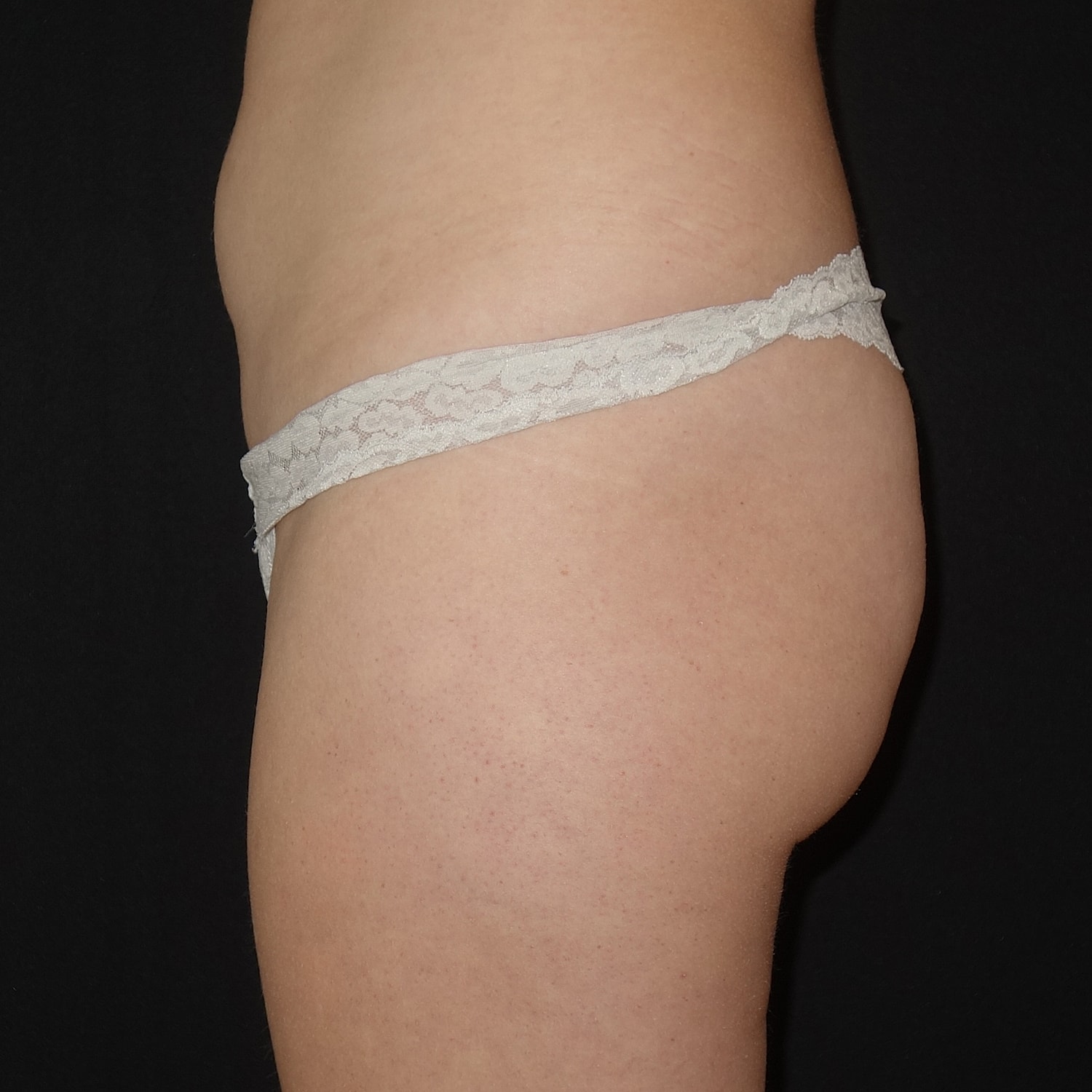Brazilian Butt Lift Before & After