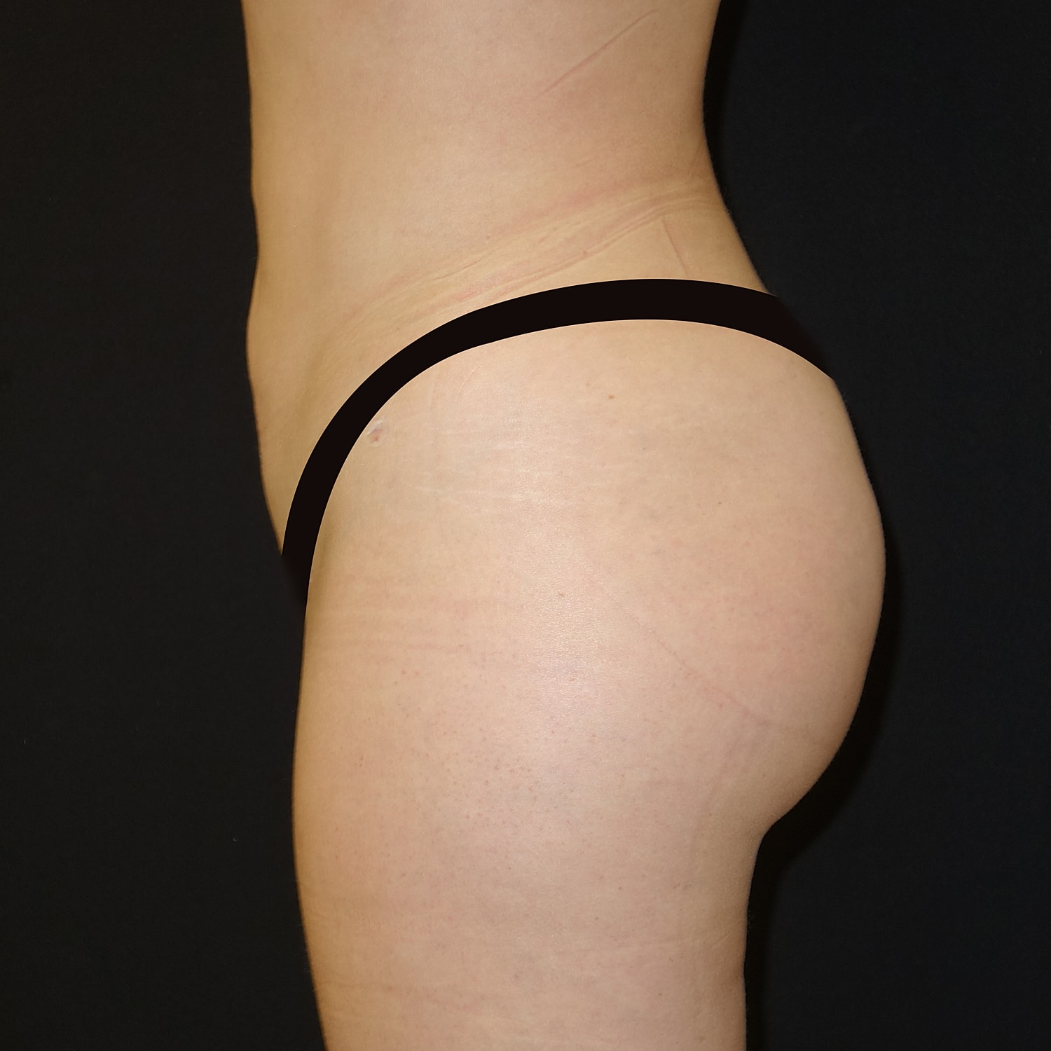 Brazilian Butt Lift Before & After