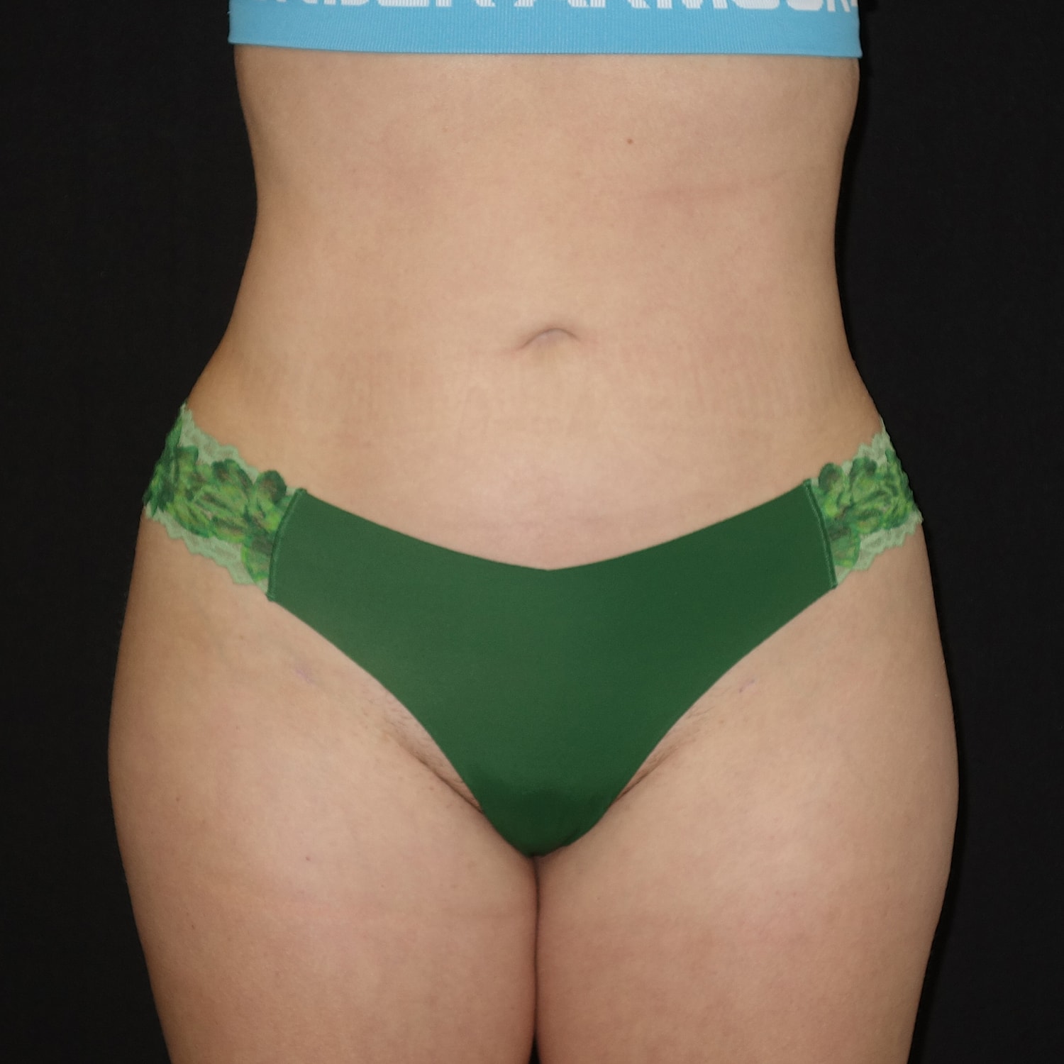 Brazilian Butt Lift Before & After