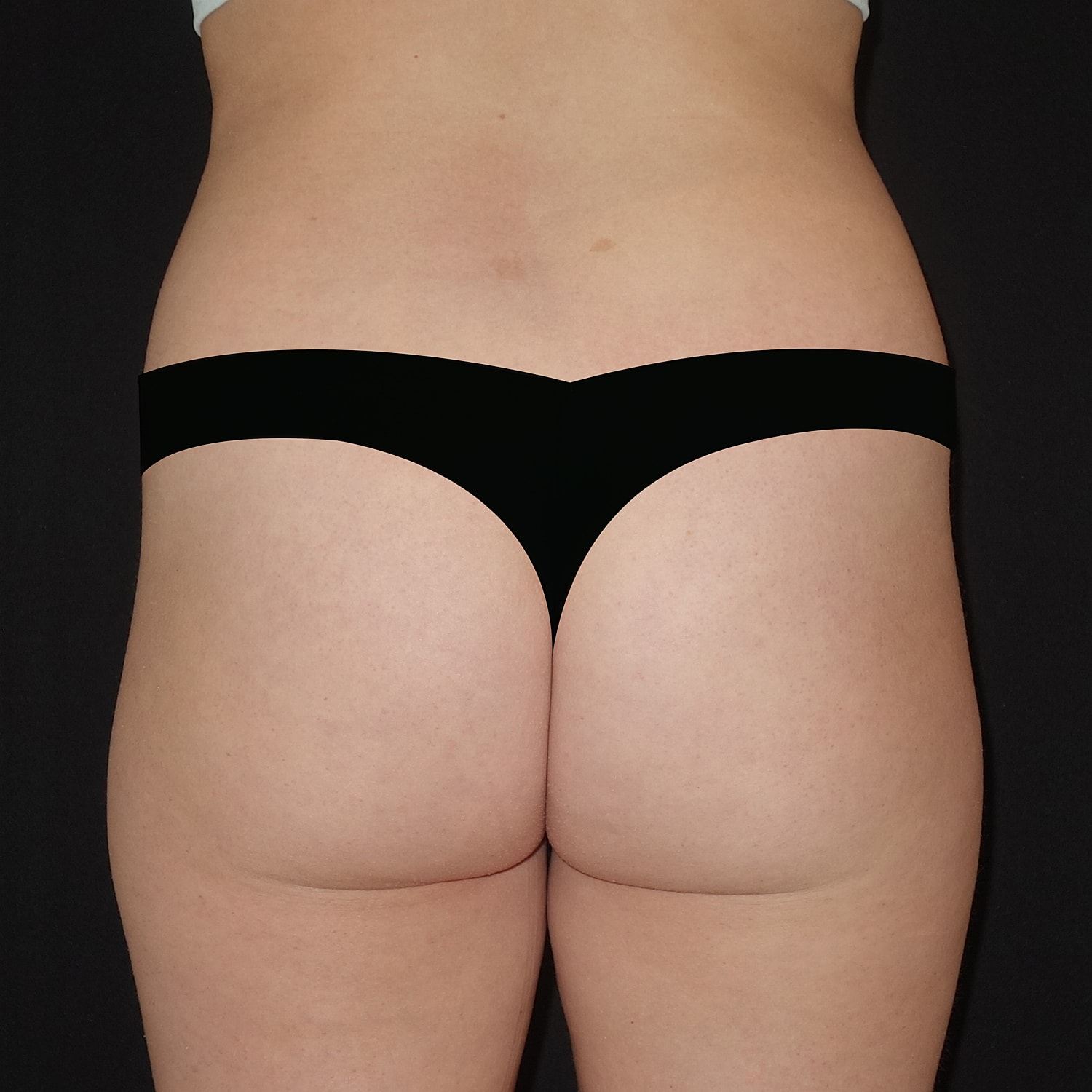 Brazilian Butt Lift Before & After