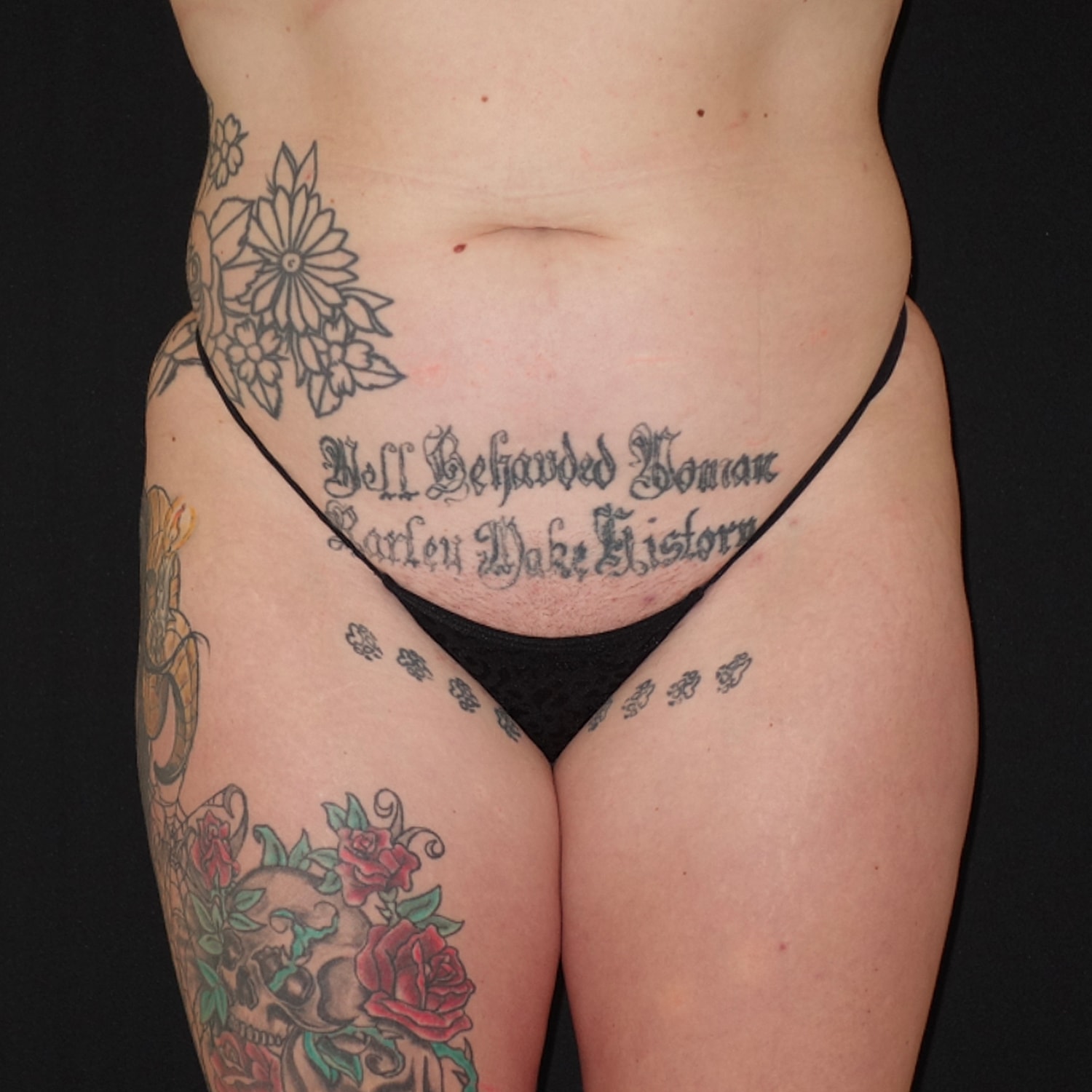 Brazilian Butt Lift Before & After