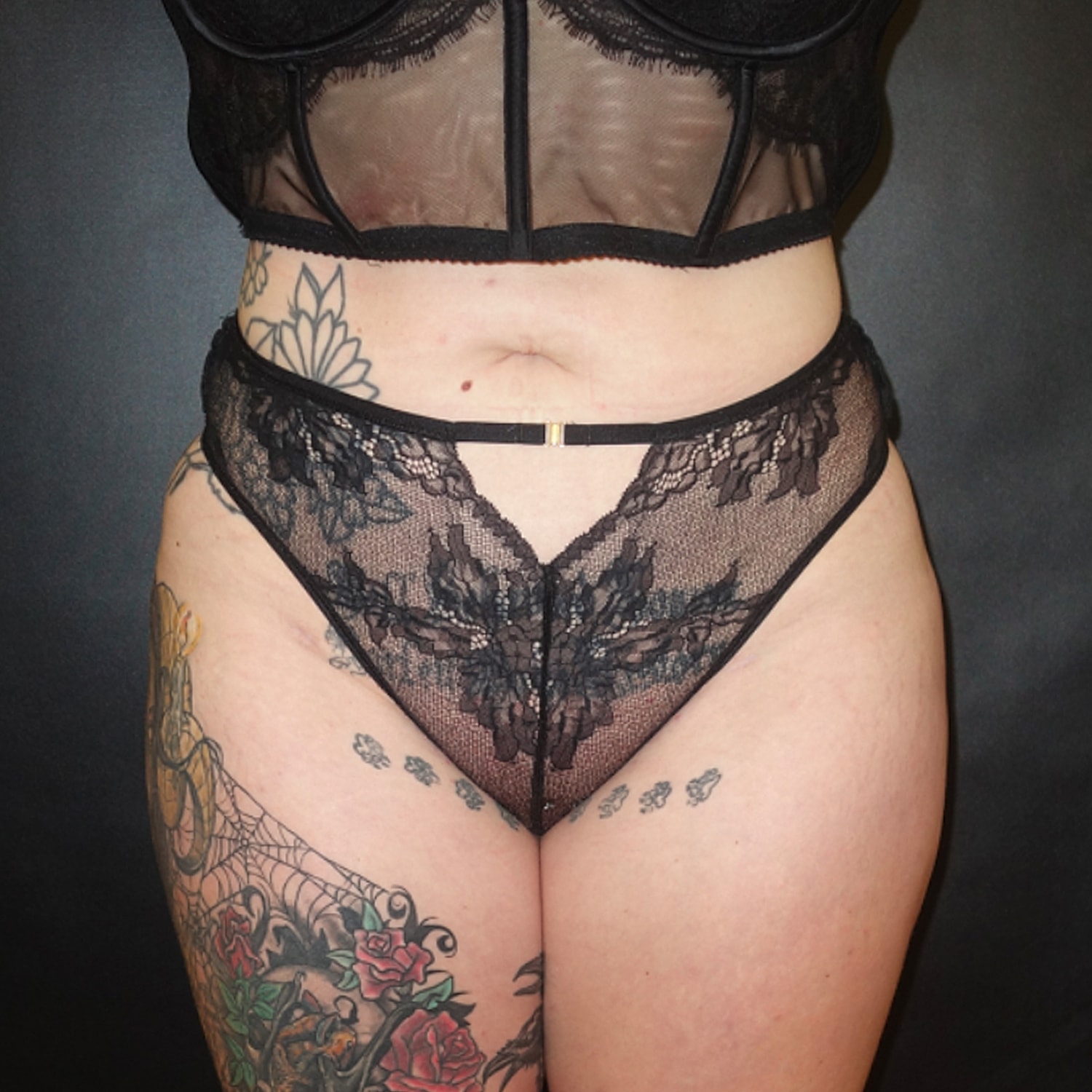 Brazilian Butt Lift Before & After