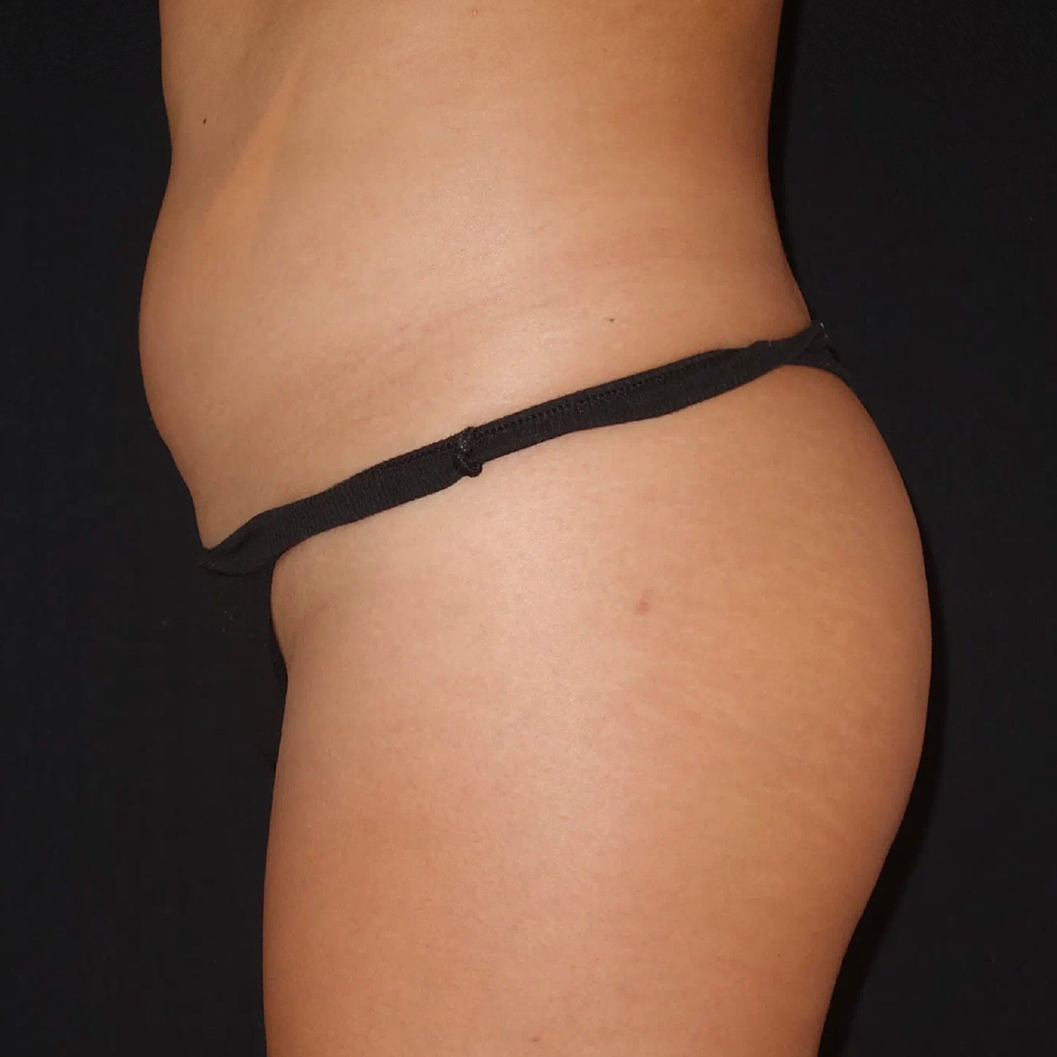 Brazilian Butt Lift Before & After