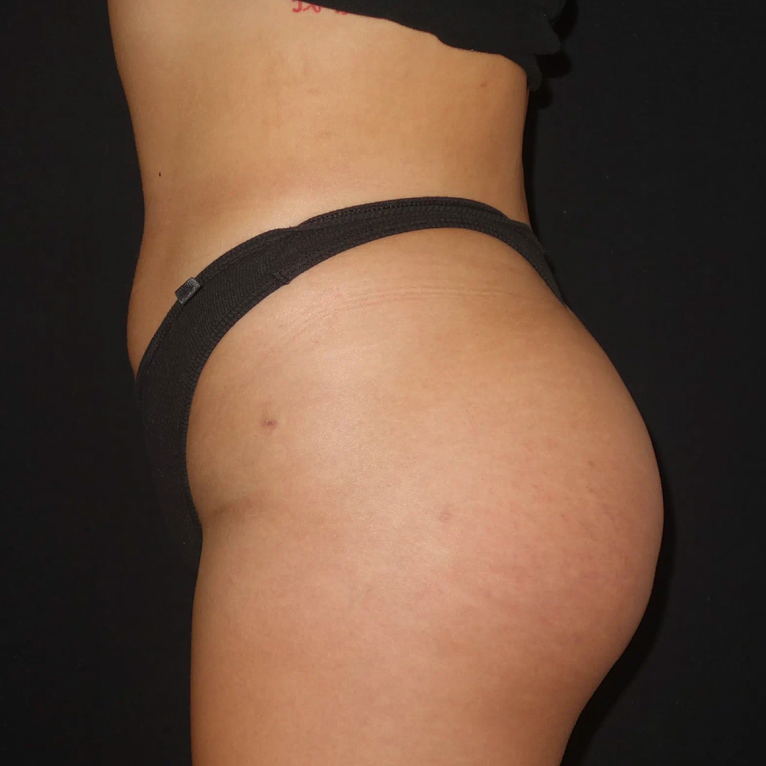 Brazilian Butt Lift Before & After
