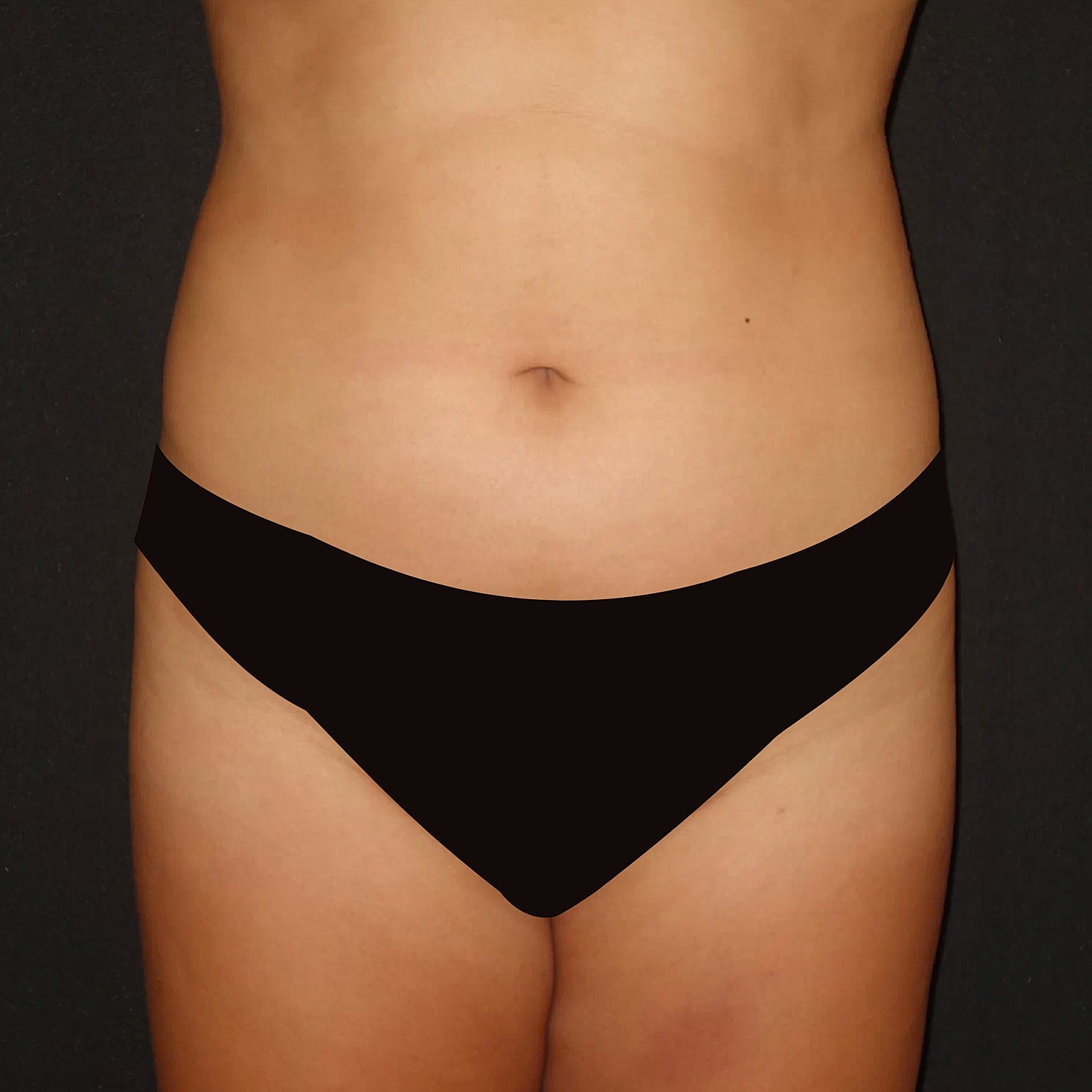 Brazilian Butt Lift Before & After