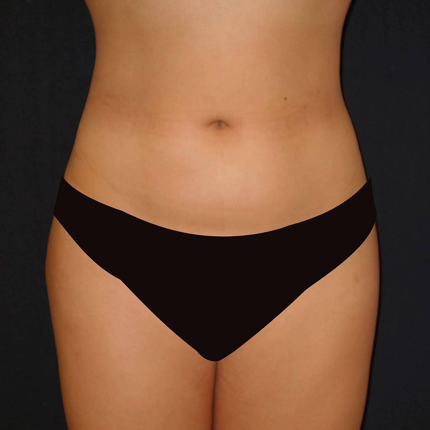 Brazilian Butt Lift Before & After