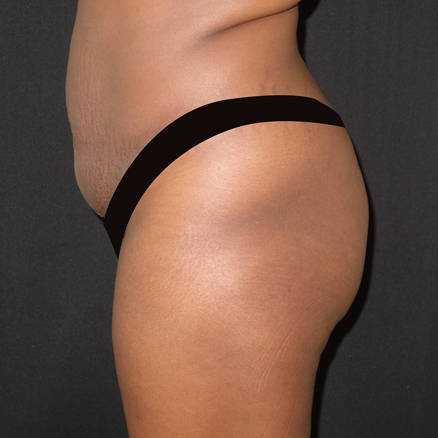 Brazilian Butt Lift Before & After