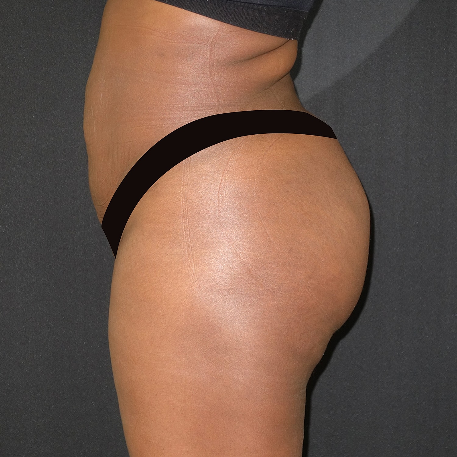 Brazilian Butt Lift Before & After
