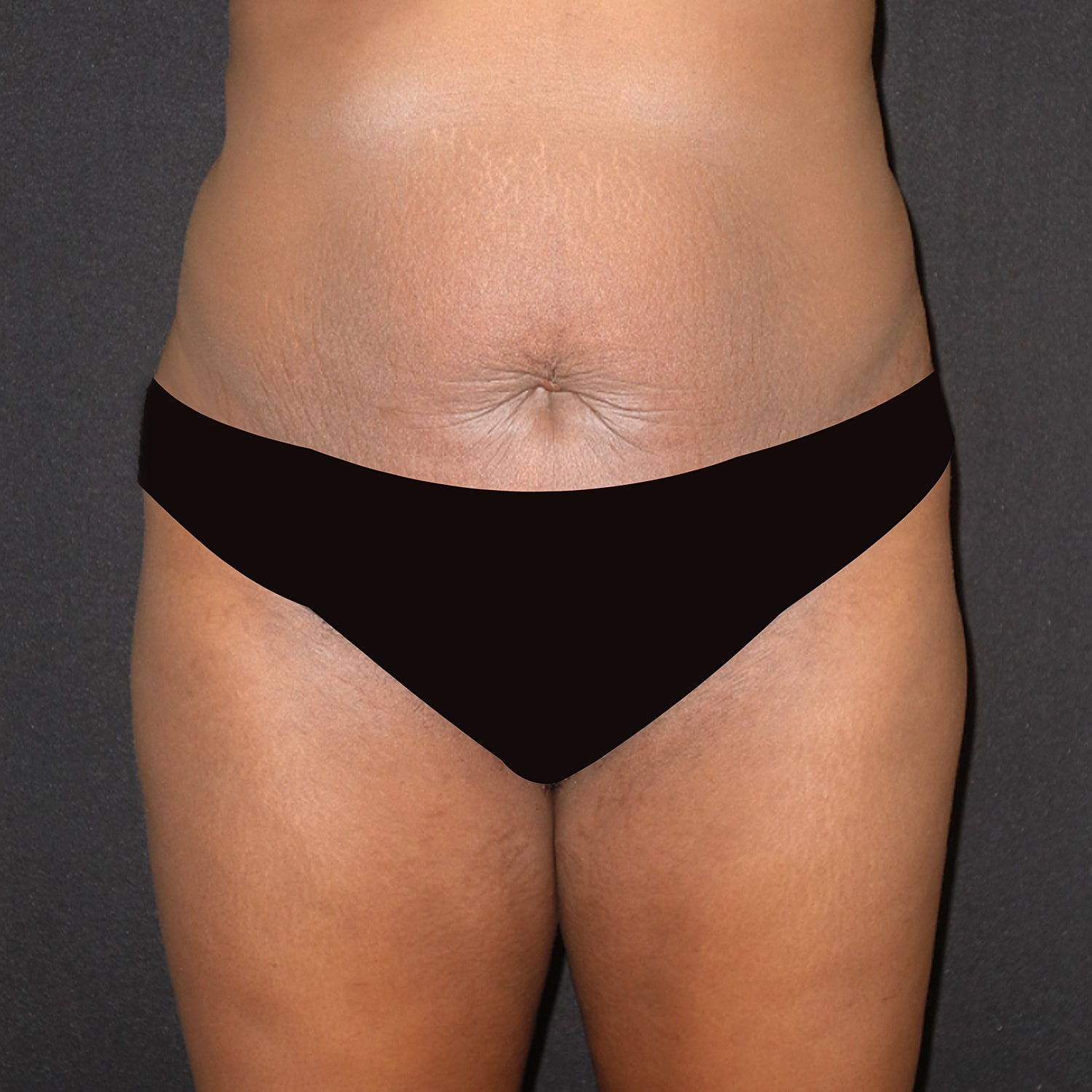 Brazilian Butt Lift Before & After