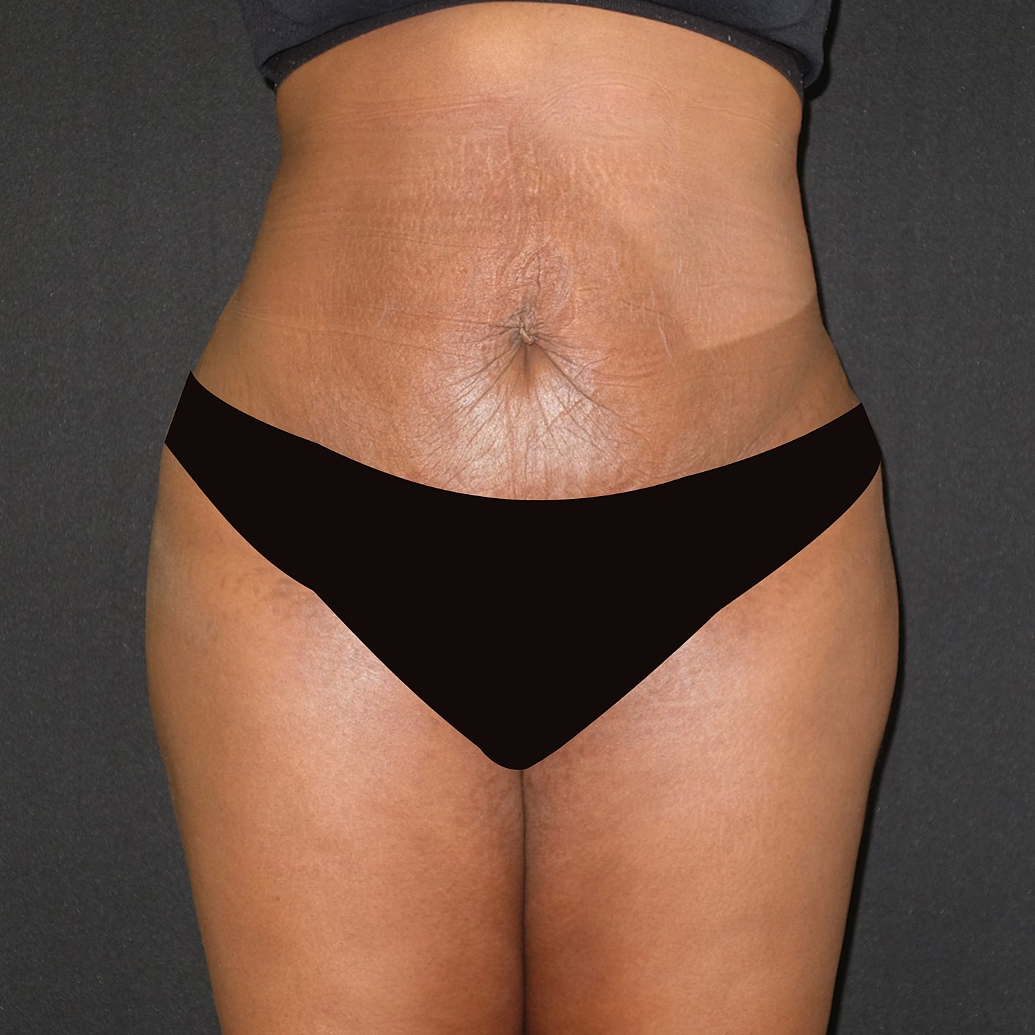Brazilian Butt Lift Before & After