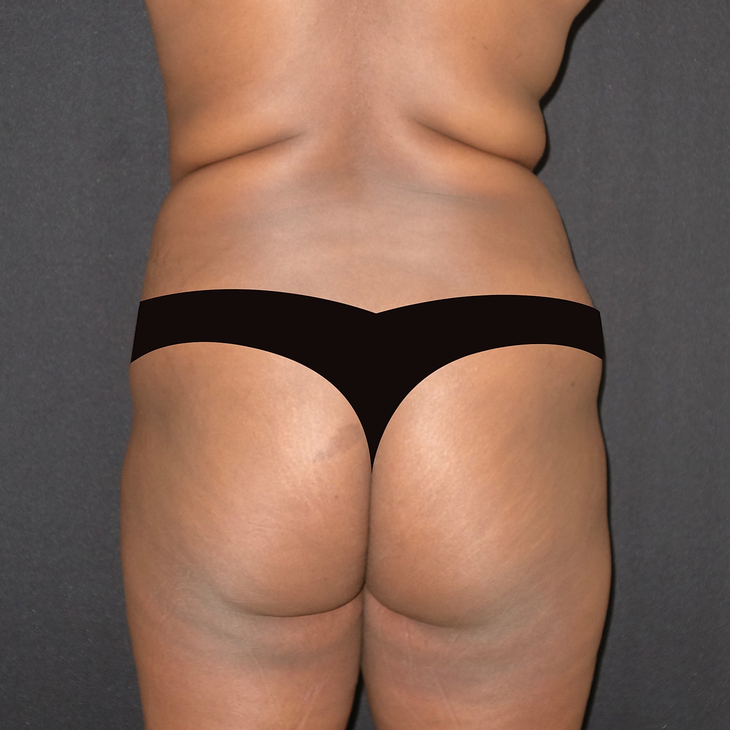 Brazilian Butt Lift Before & After