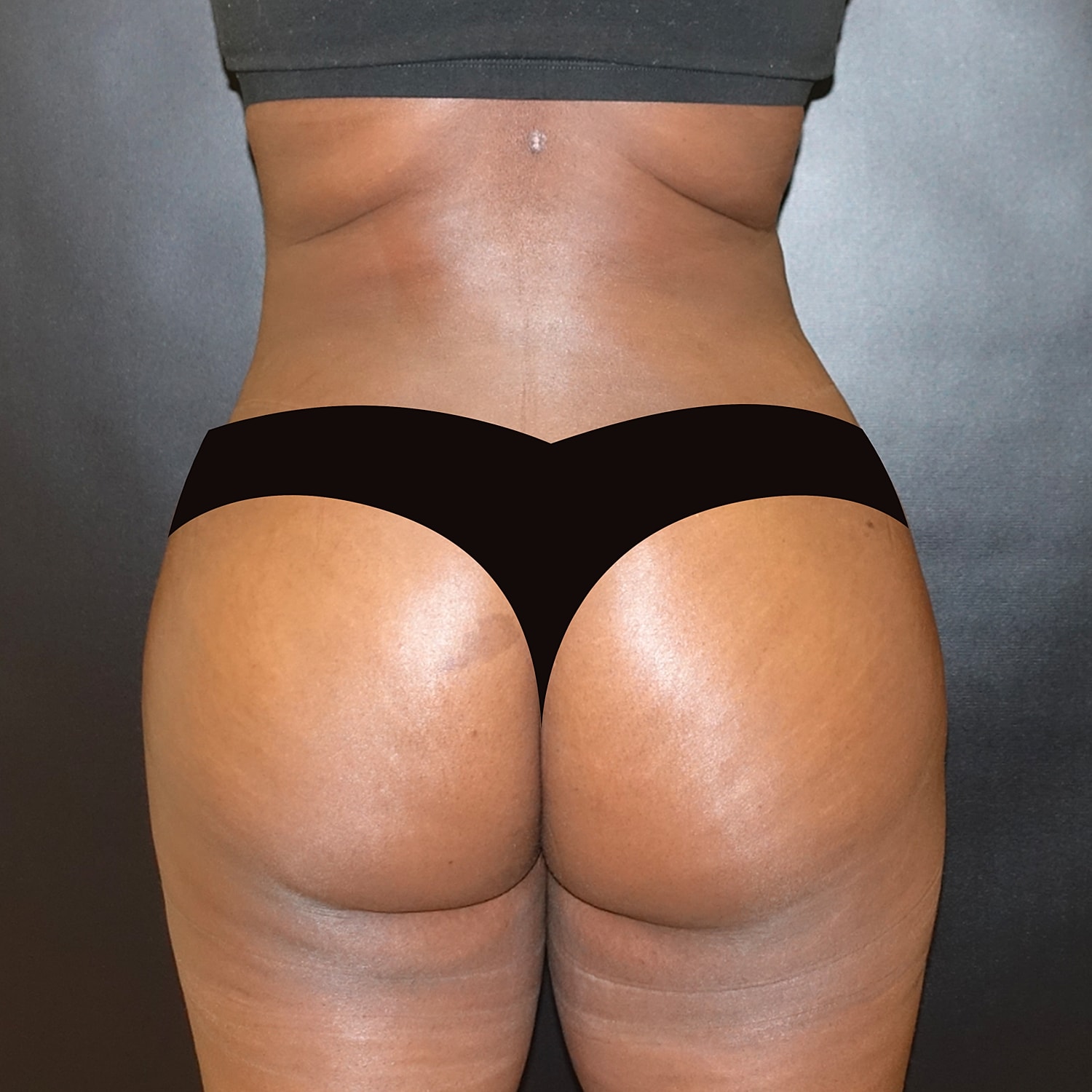 Brazilian Butt Lift Before & After