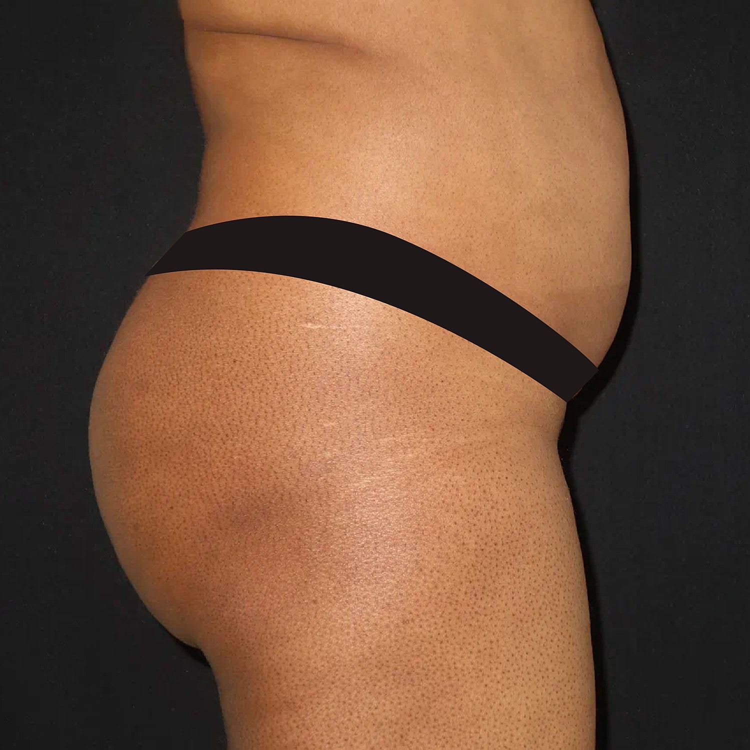 Brazilian Butt Lift Before & After