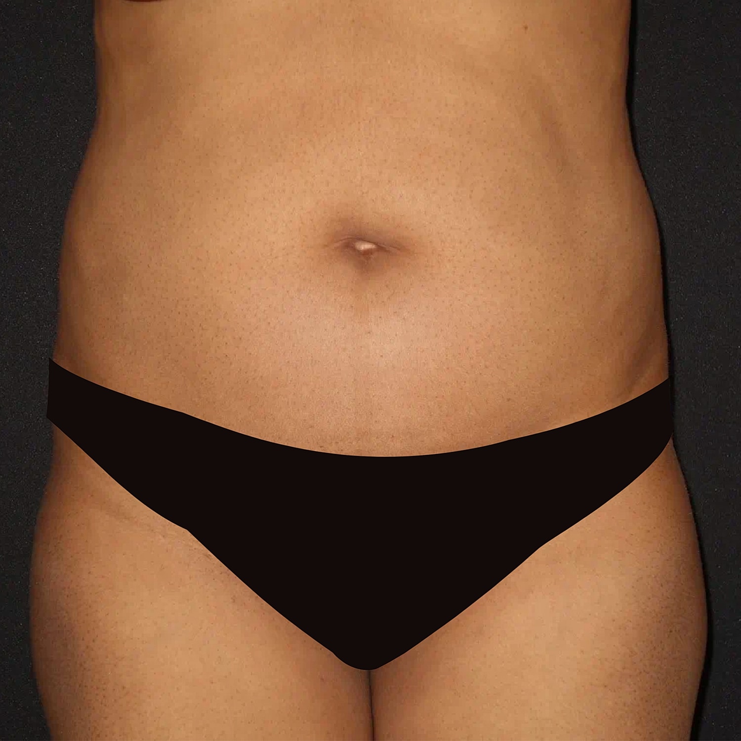 Brazilian Butt Lift Before & After
