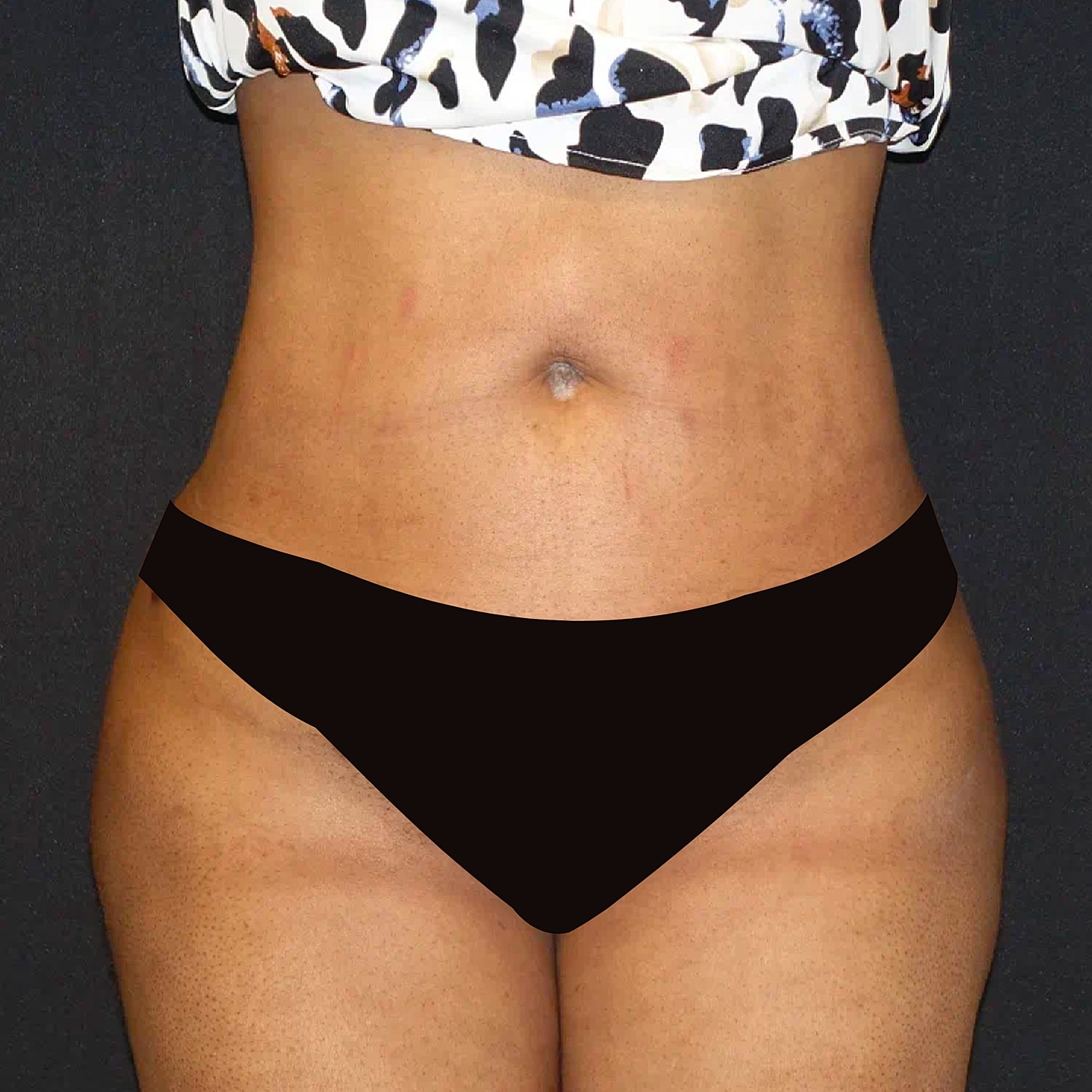 Brazilian Butt Lift Before & After