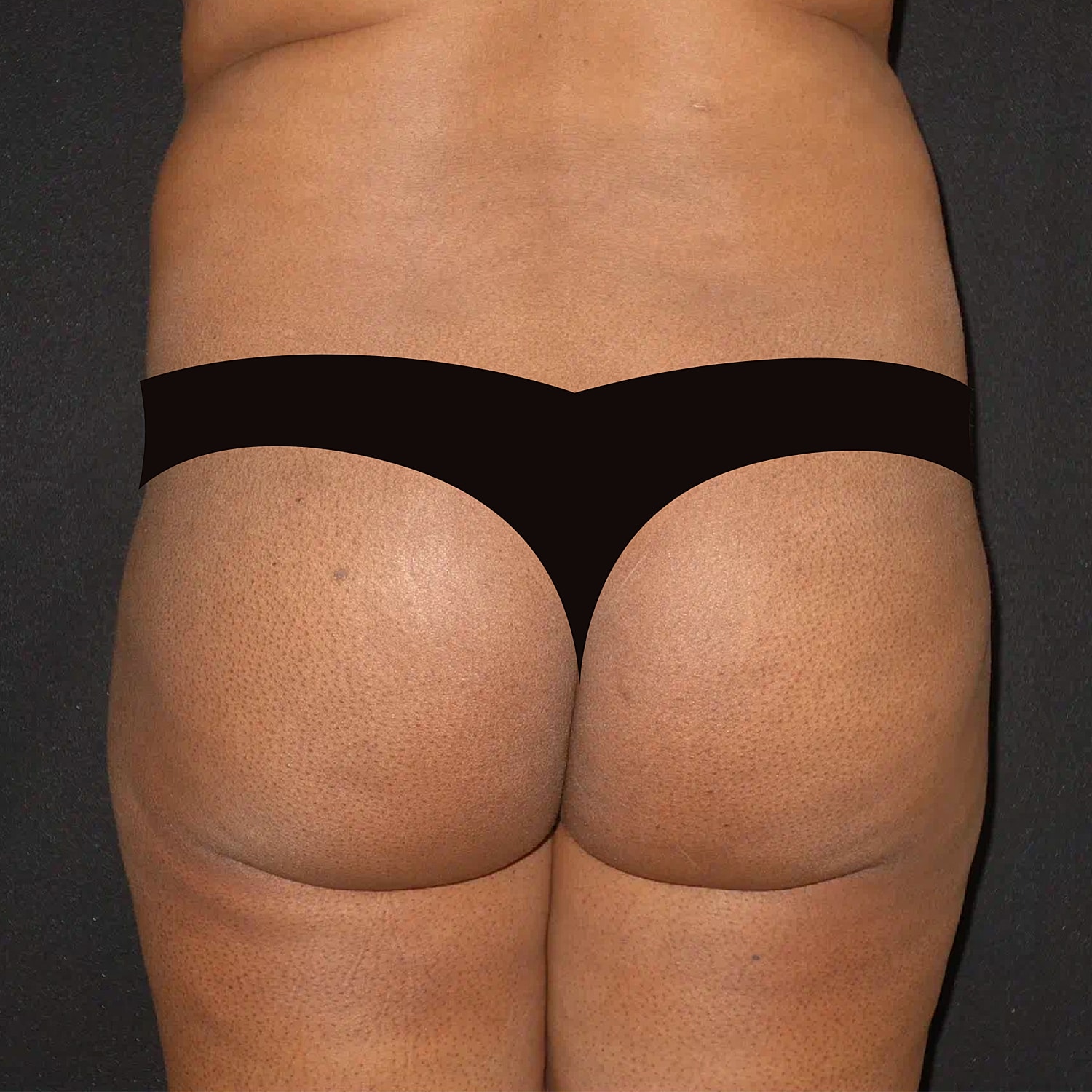 Brazilian Butt Lift Before & After