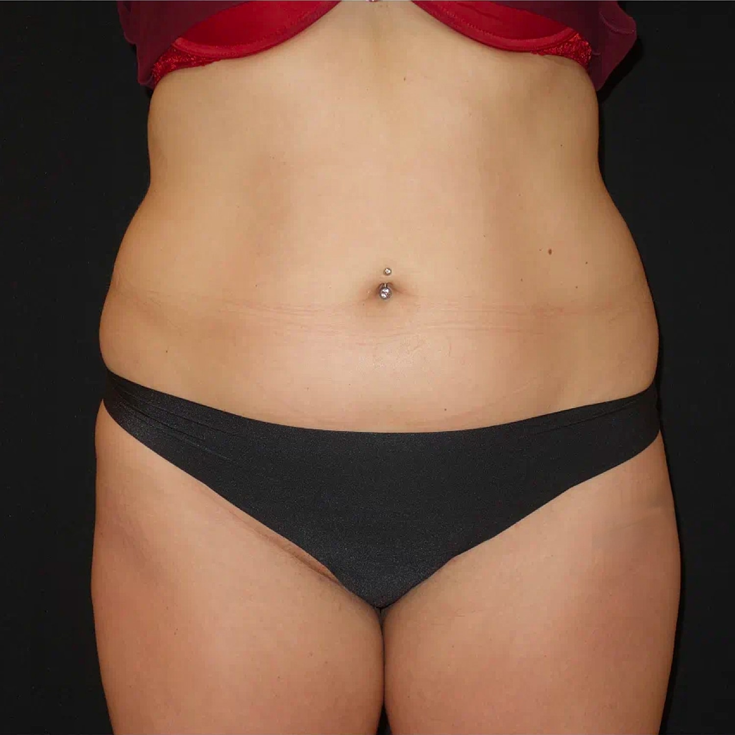Brazilian Butt Lift Before & After