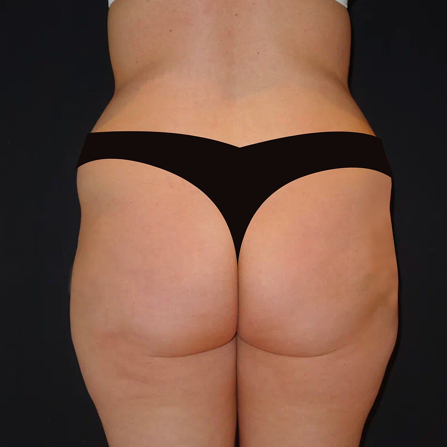 Brazilian Butt Lift Before & After
