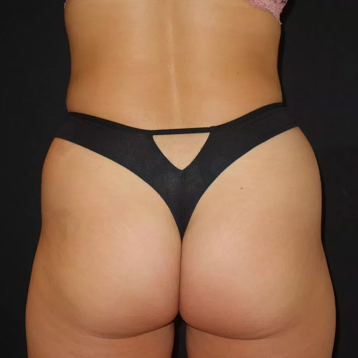 Brazilian Butt Lift Before & After