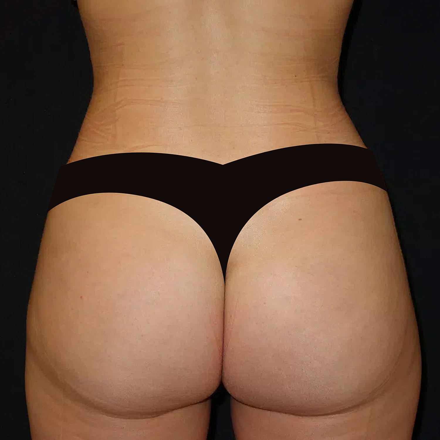 Brazilian Butt Lift Before & After