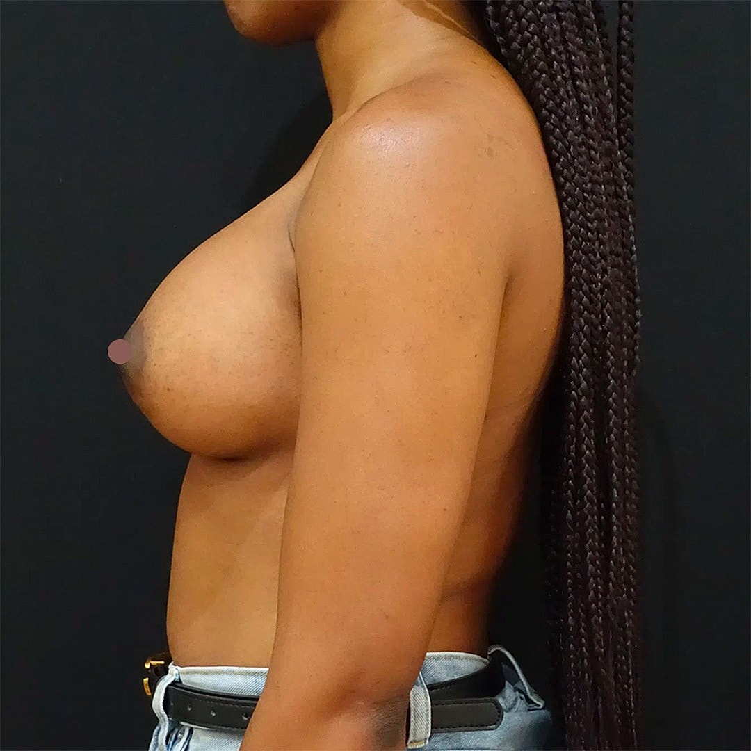 Breast Augmentation Before & After